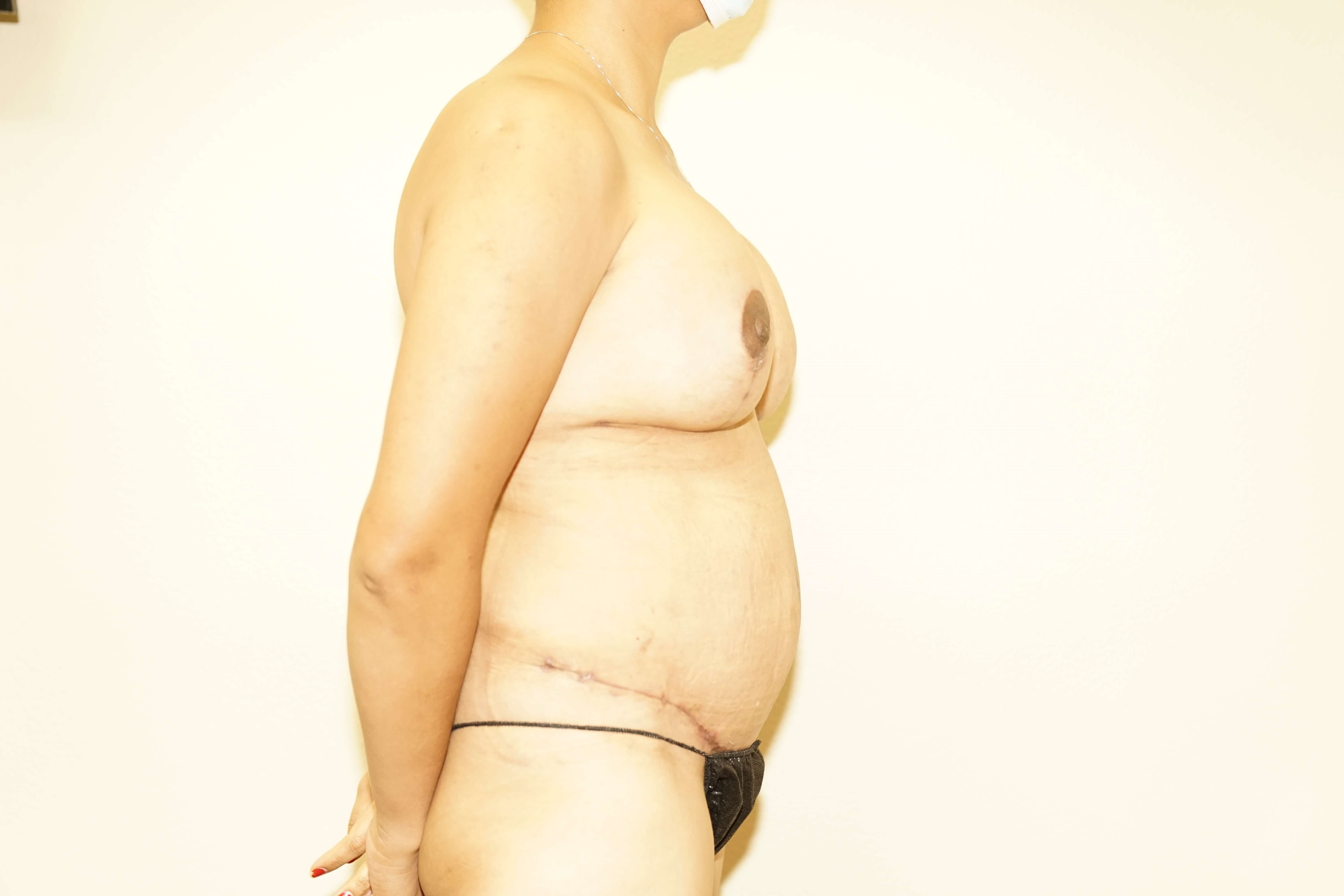 Woman has Mommy Makeover After