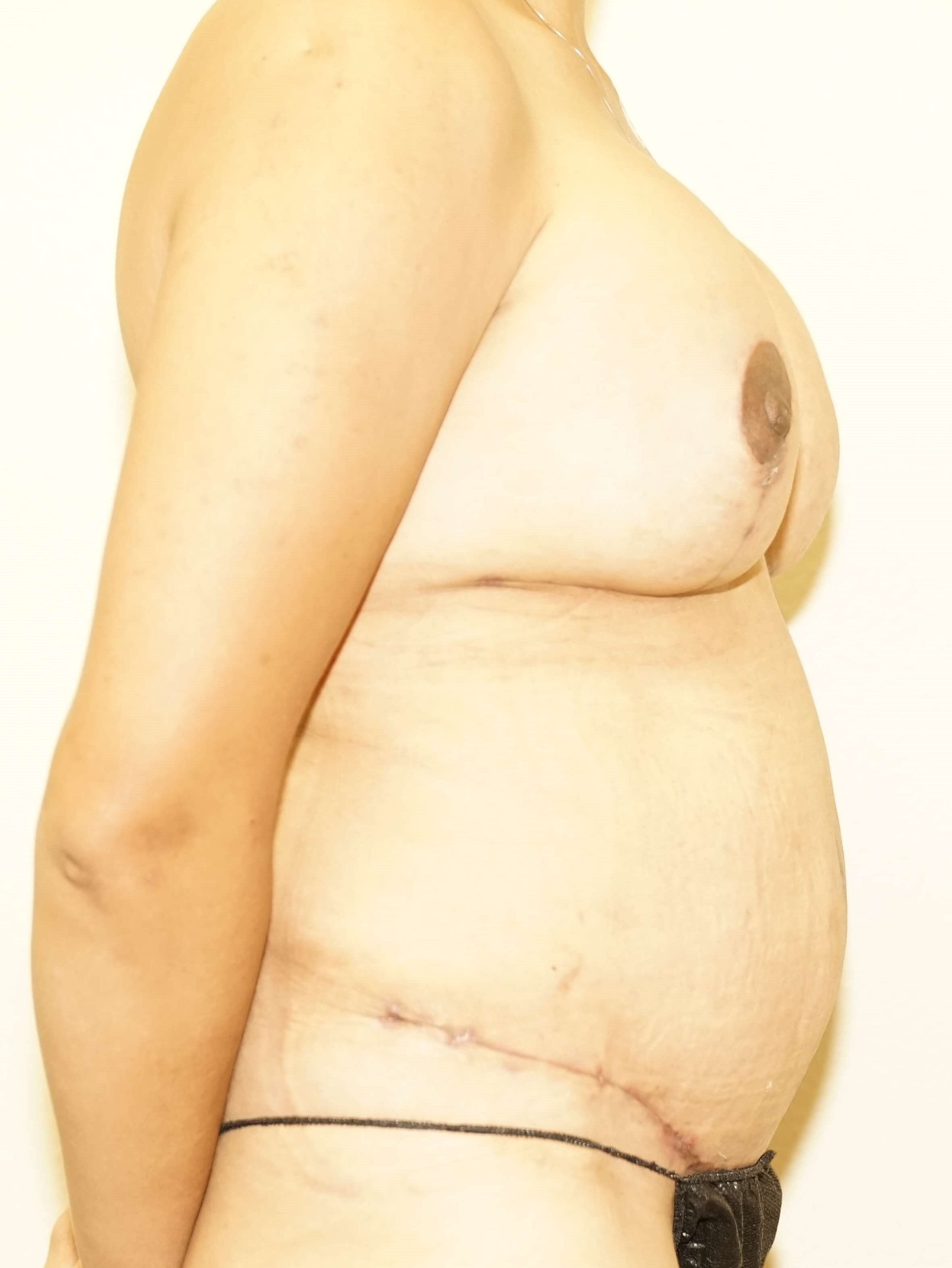 Woman has Mommy Makeover After