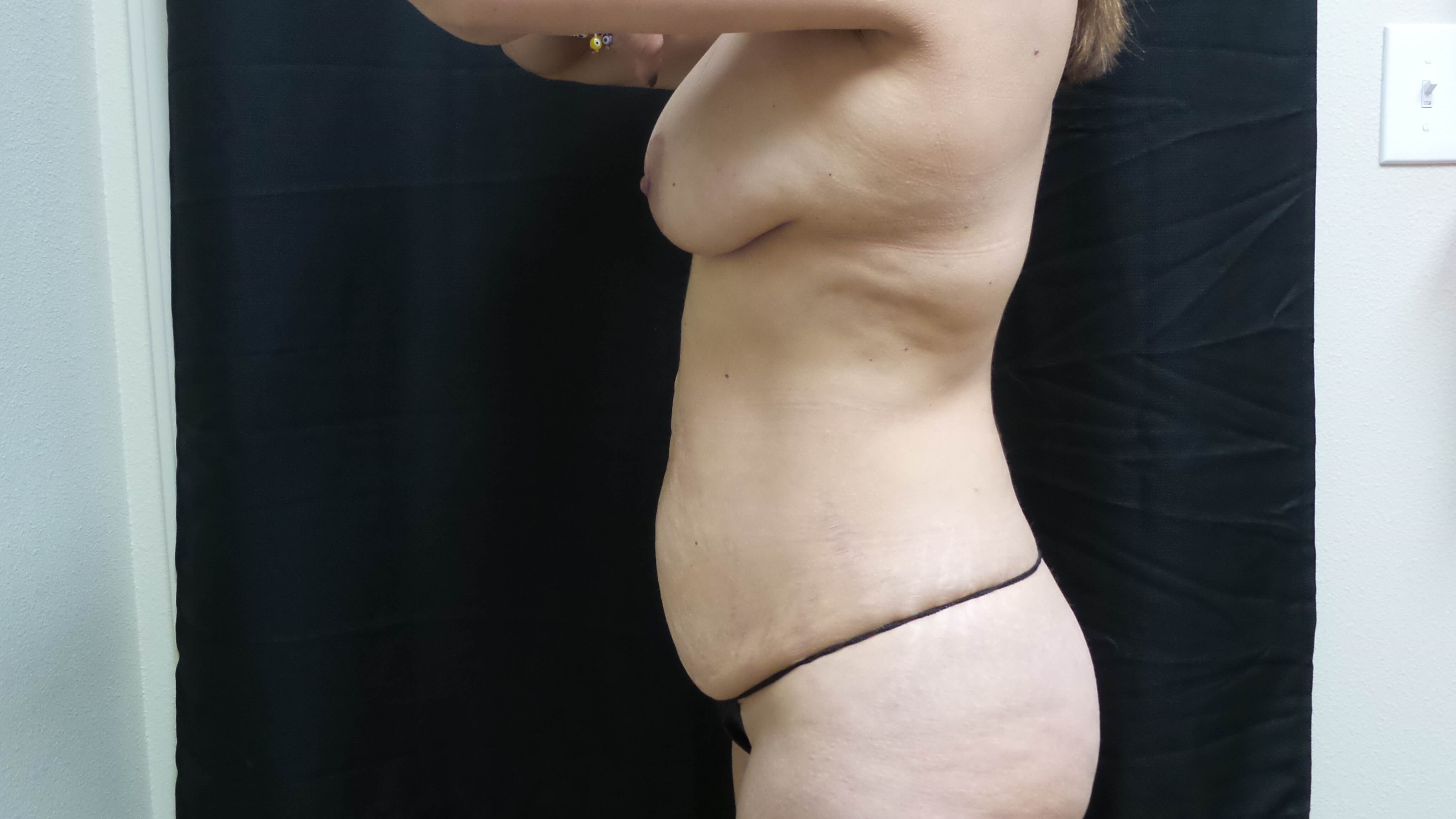 Woman has Mommy Makeover Before