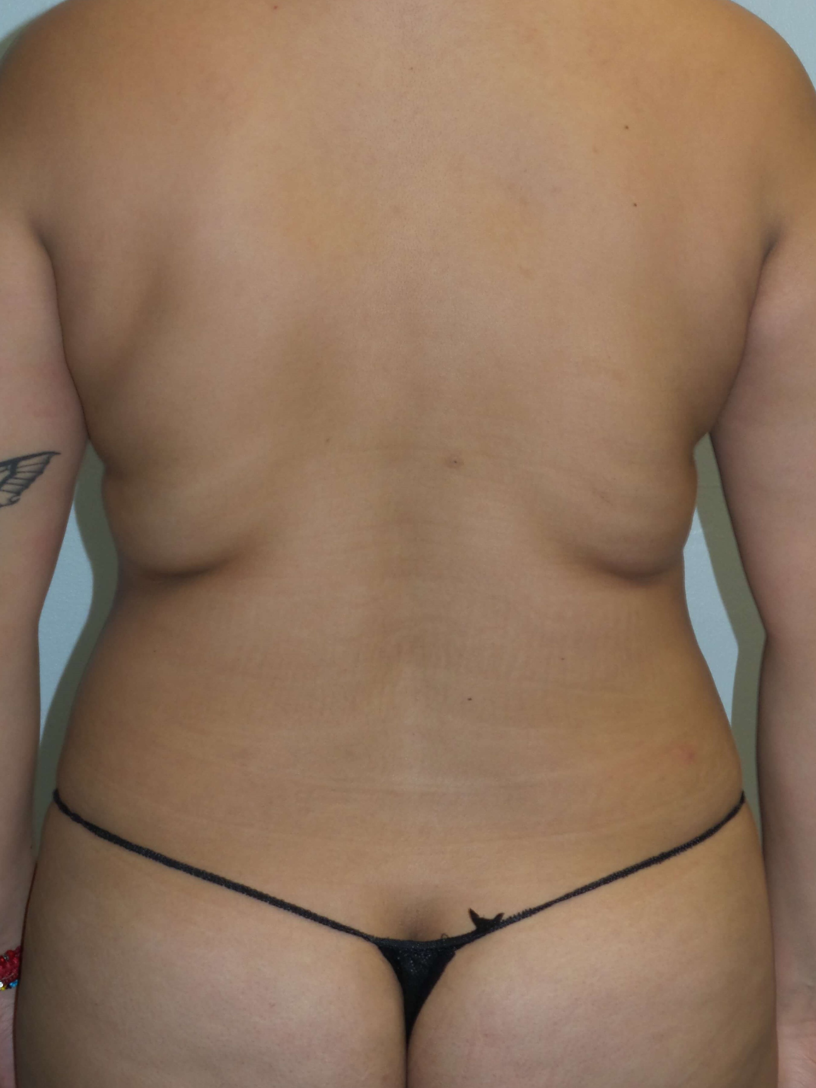 Westlake Woman Has Liposuction Before