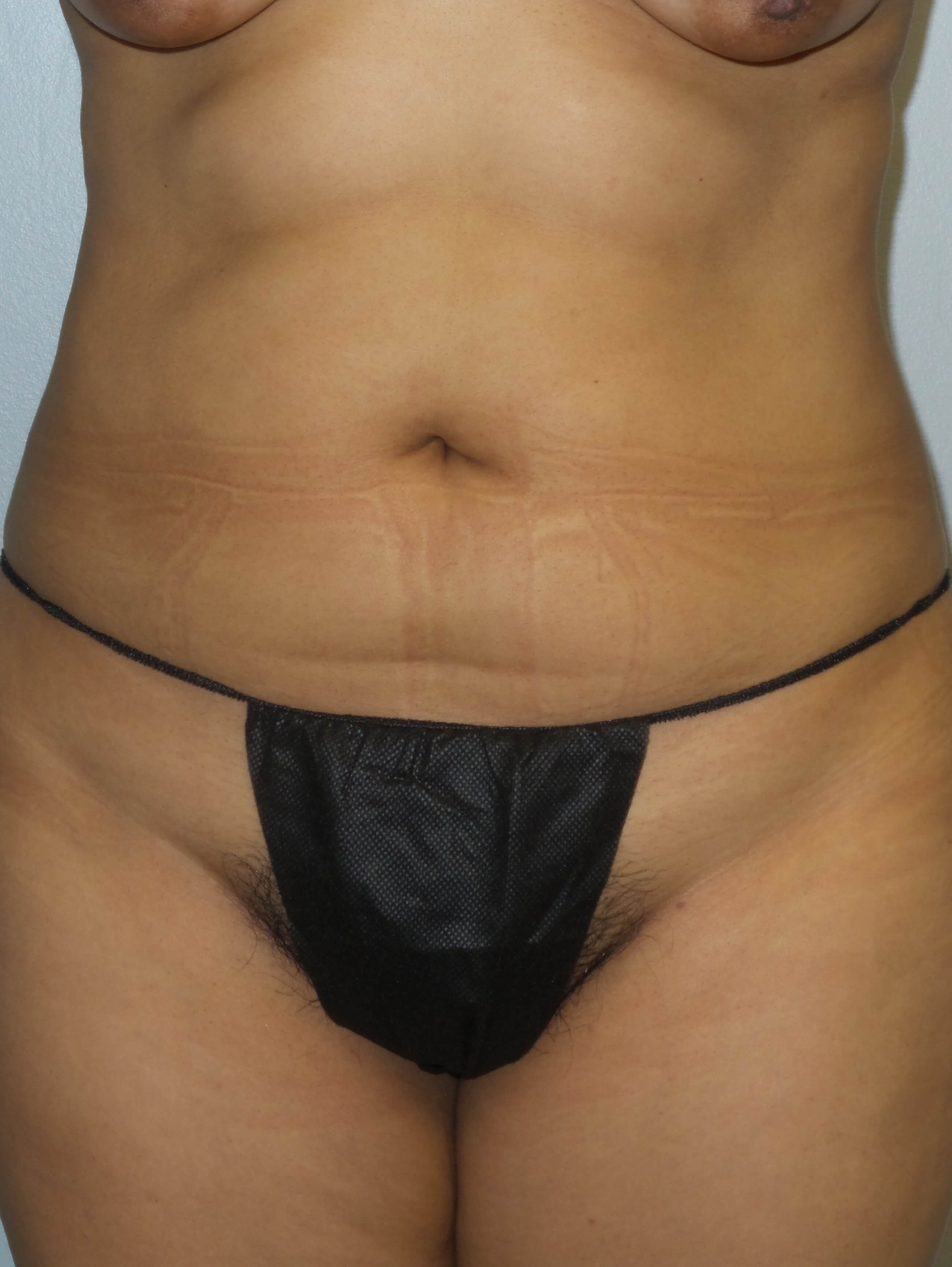 Westlake Woman Has Liposuction Before