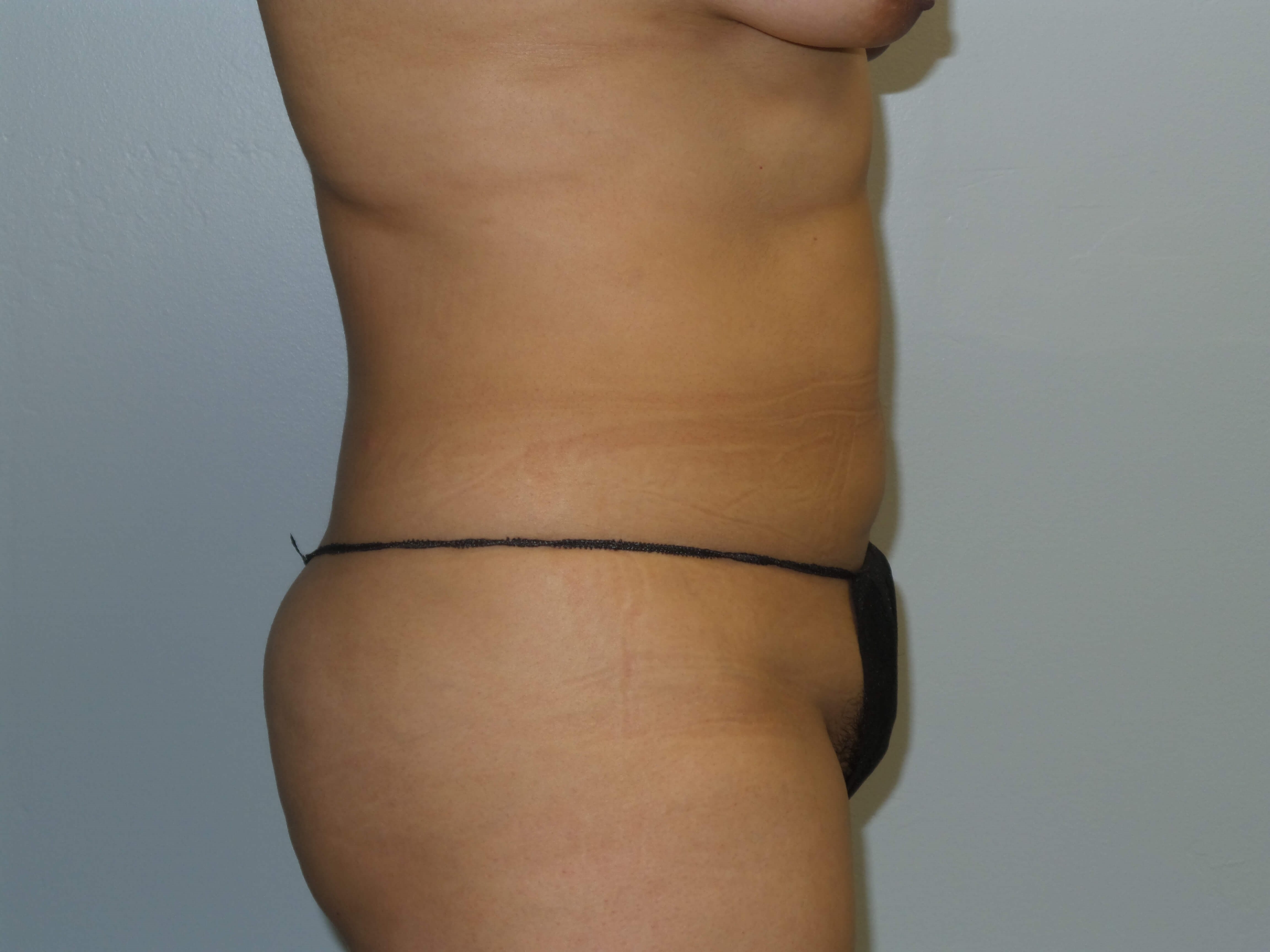 Westlake Woman Has Liposuction Before