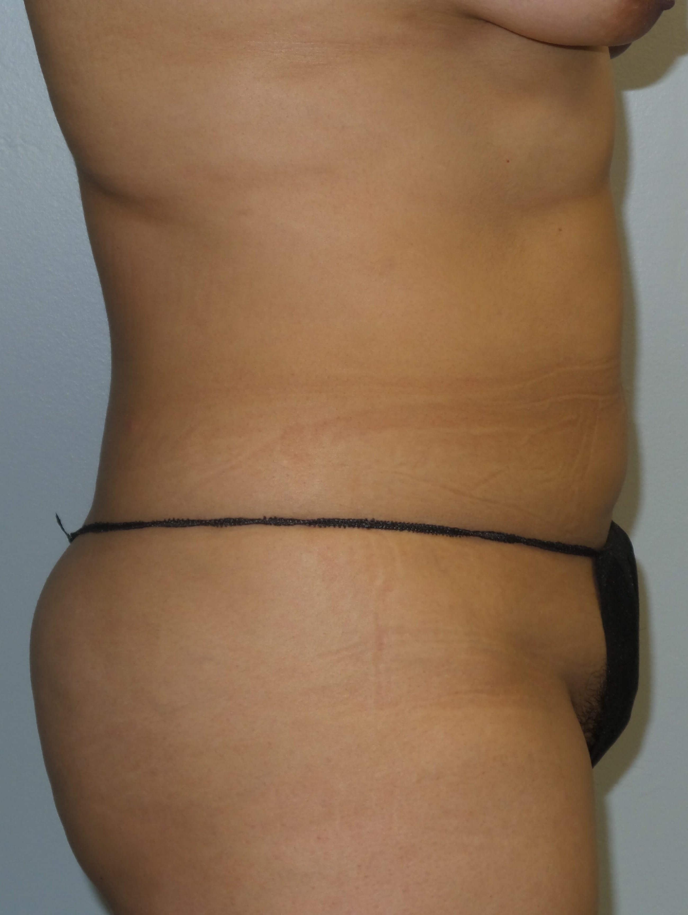 Westlake Woman Has Liposuction Before