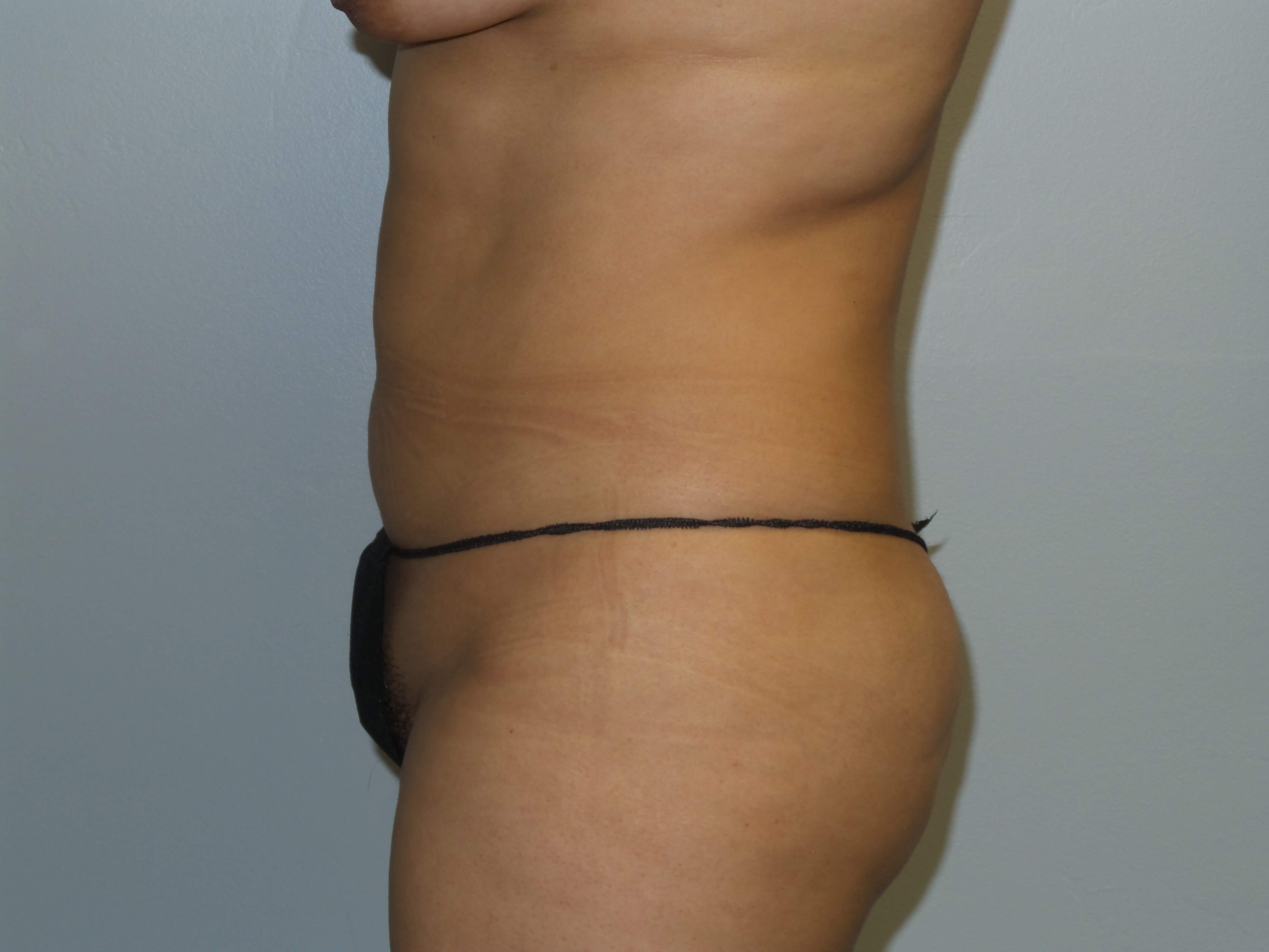 Westlake Woman Has Liposuction Before