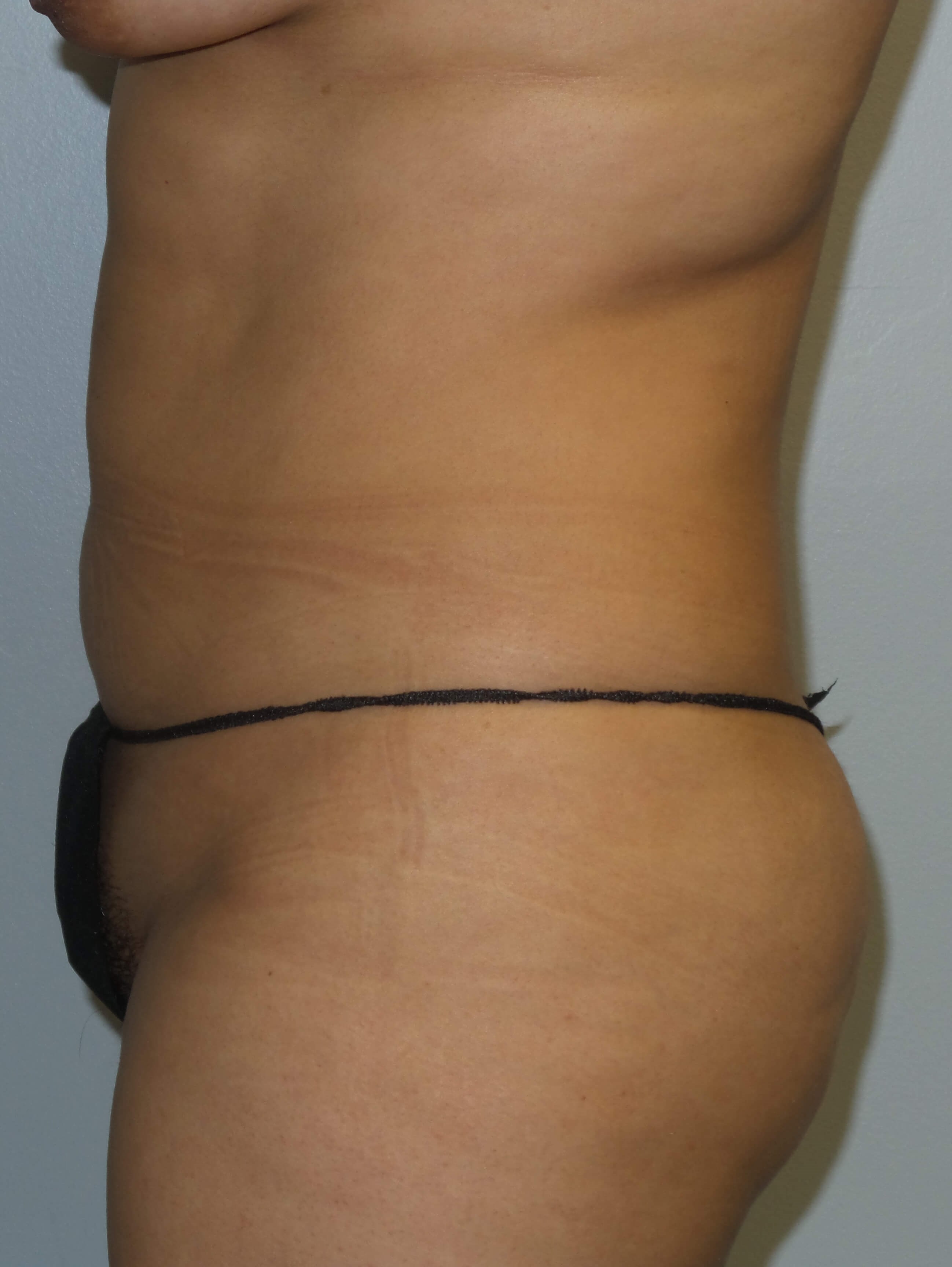 Westlake Woman Has Liposuction Before