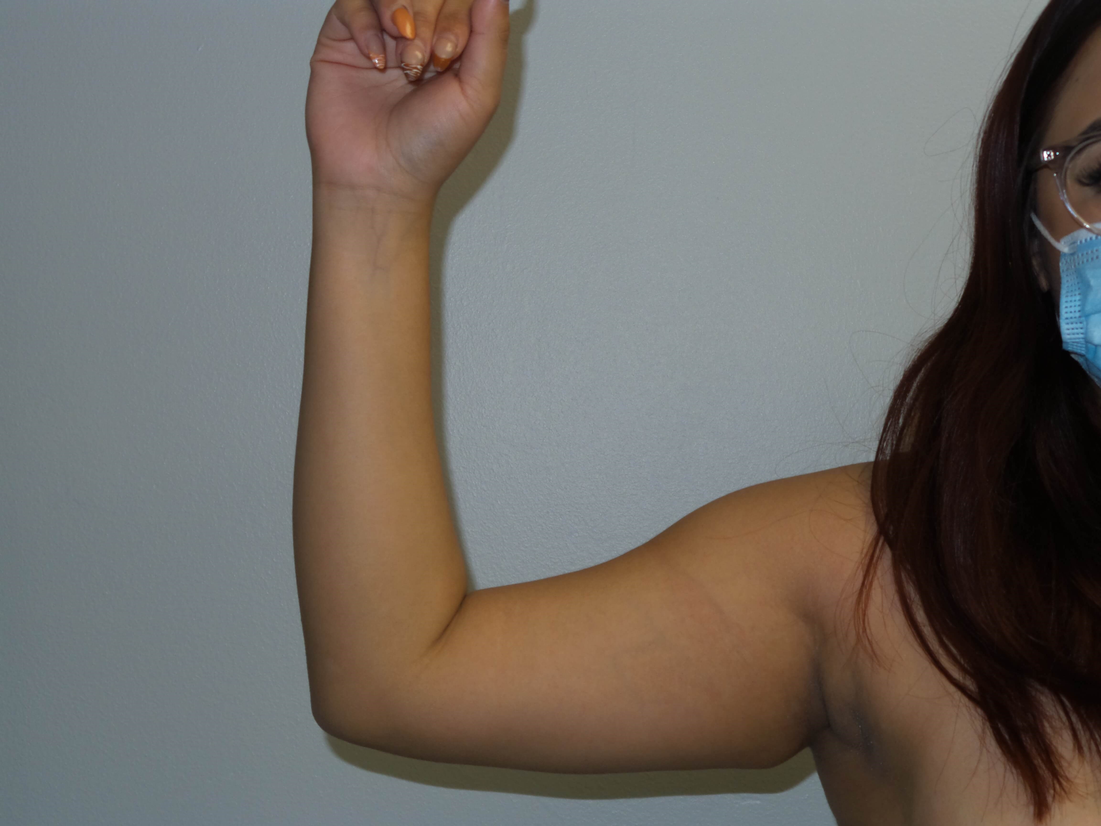 Westlake Woman Has Liposuction Before