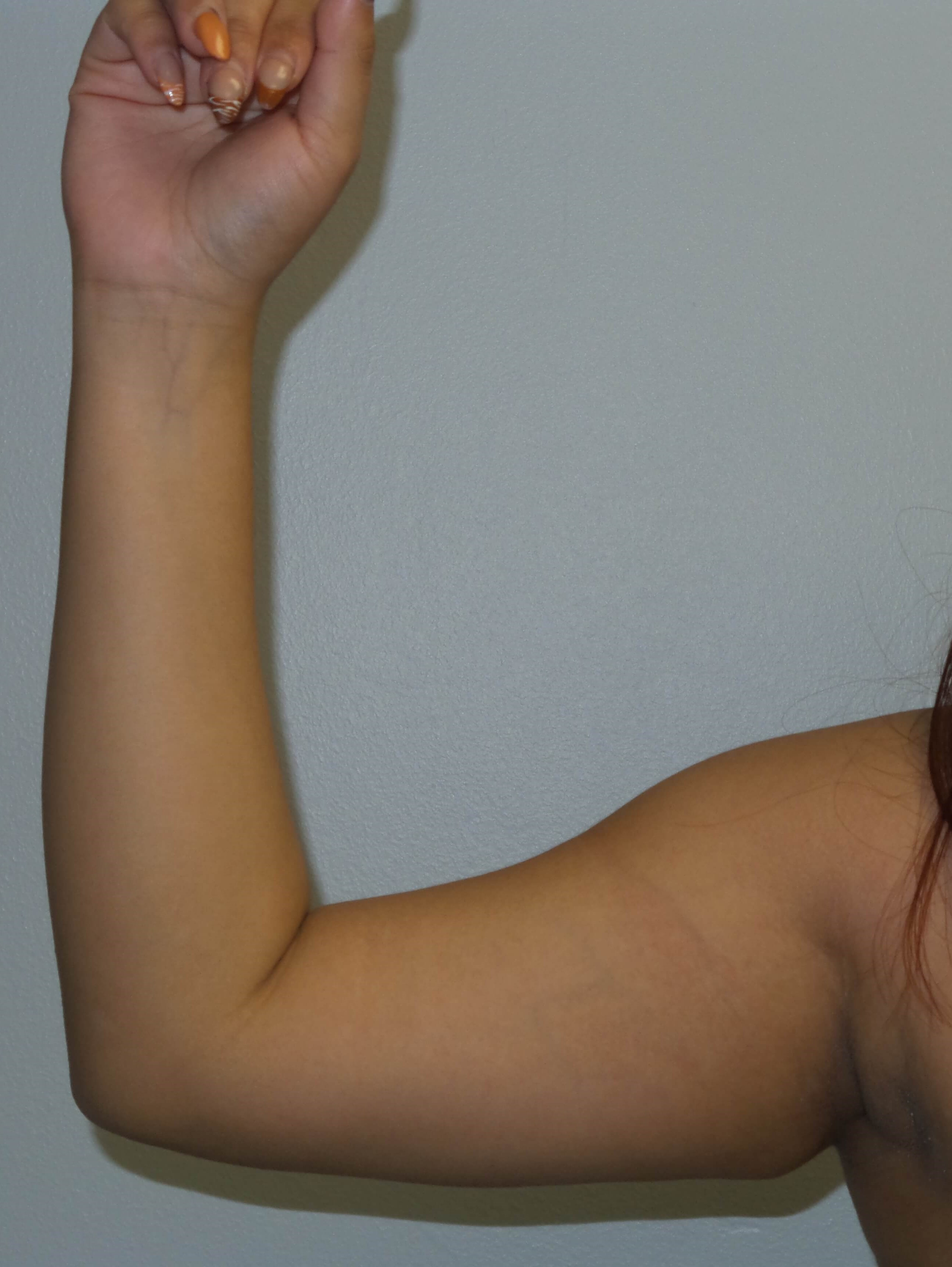 Westlake Woman Has Liposuction Before