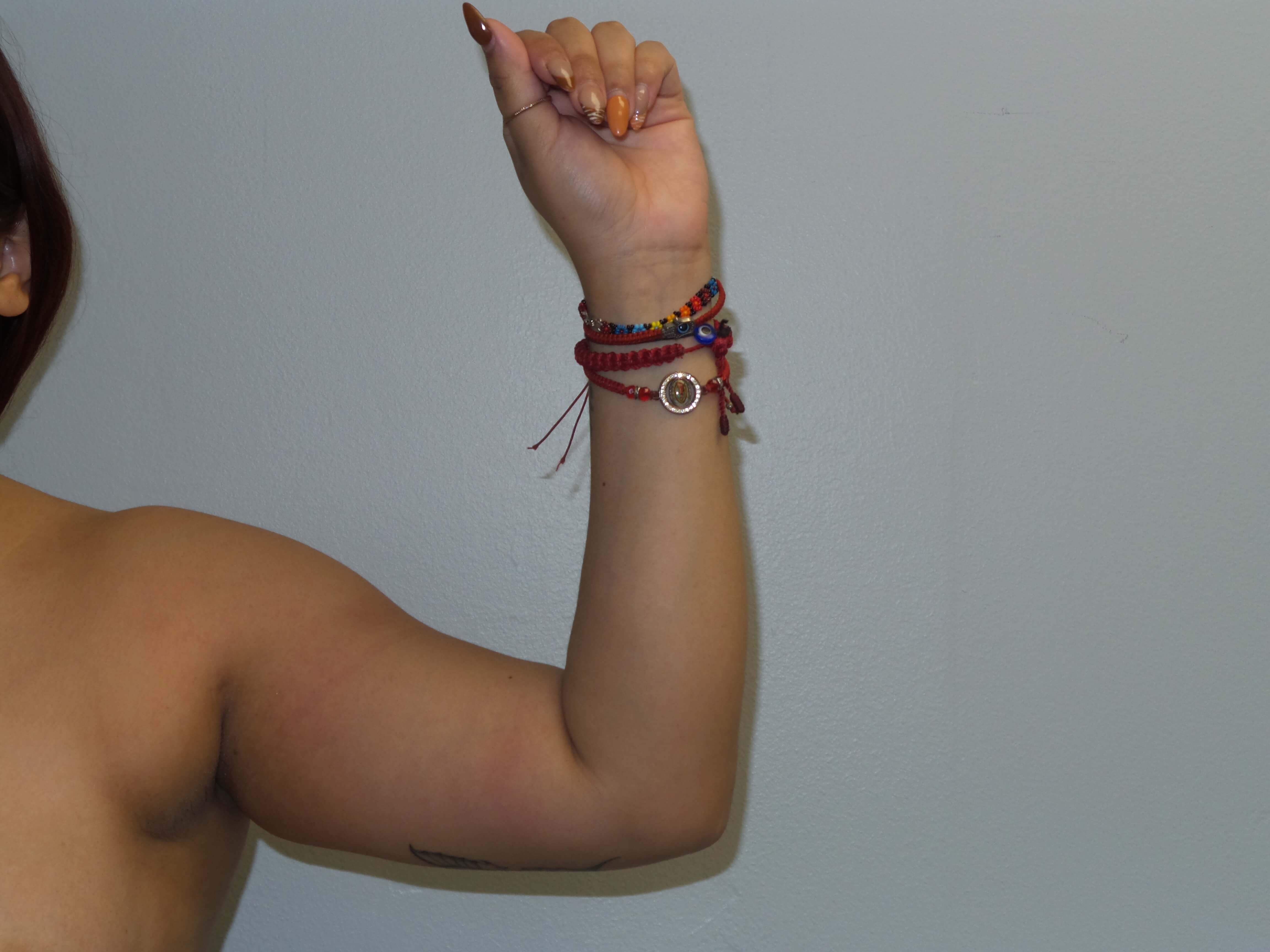 Westlake Woman Has Liposuction Before