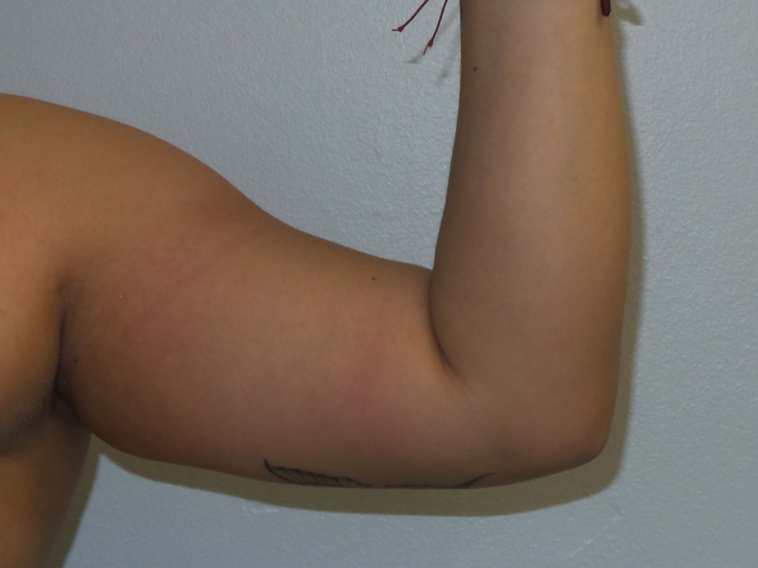 Westlake Woman Has Liposuction Before