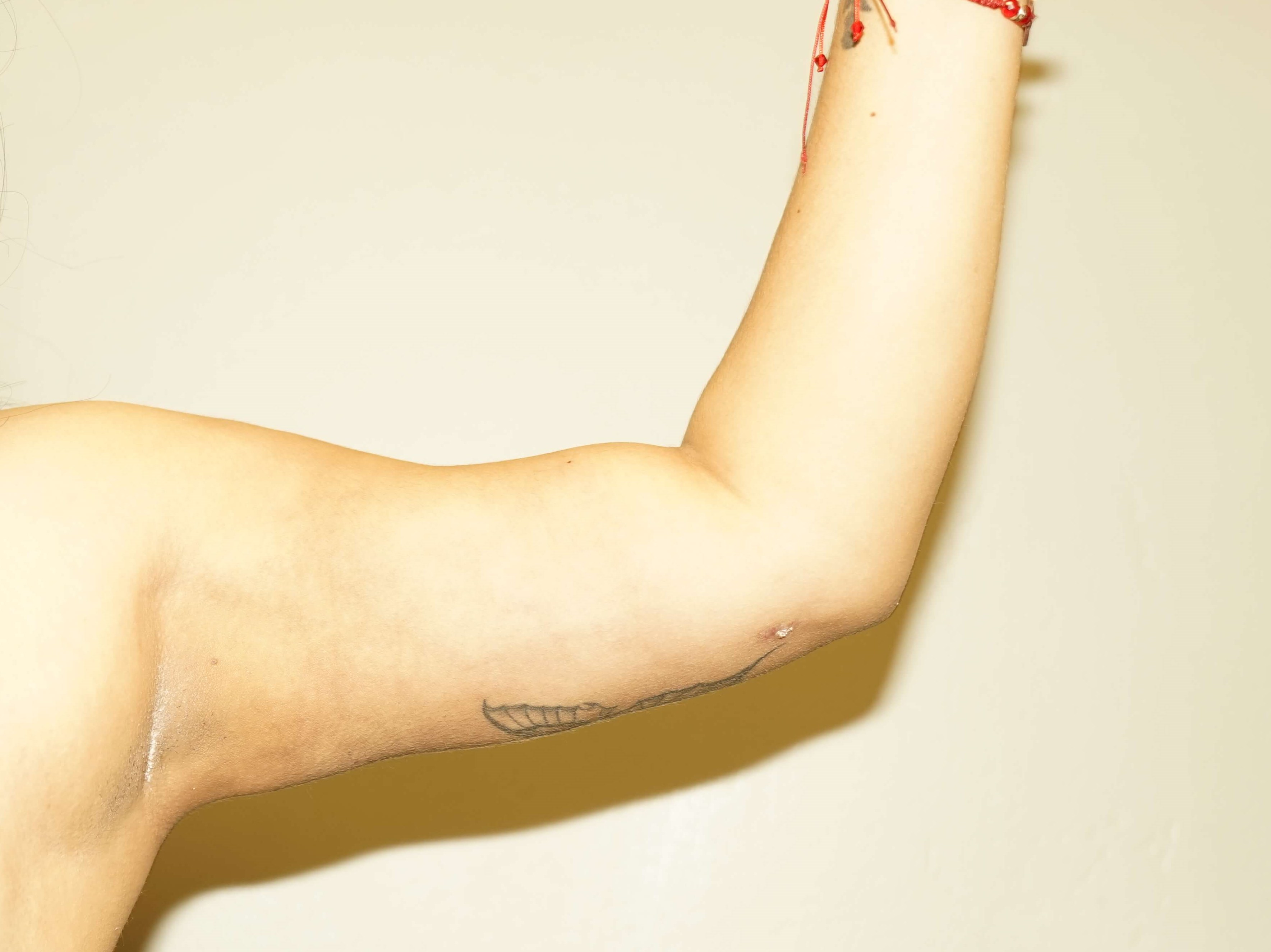 Westlake Woman Has Liposuction After