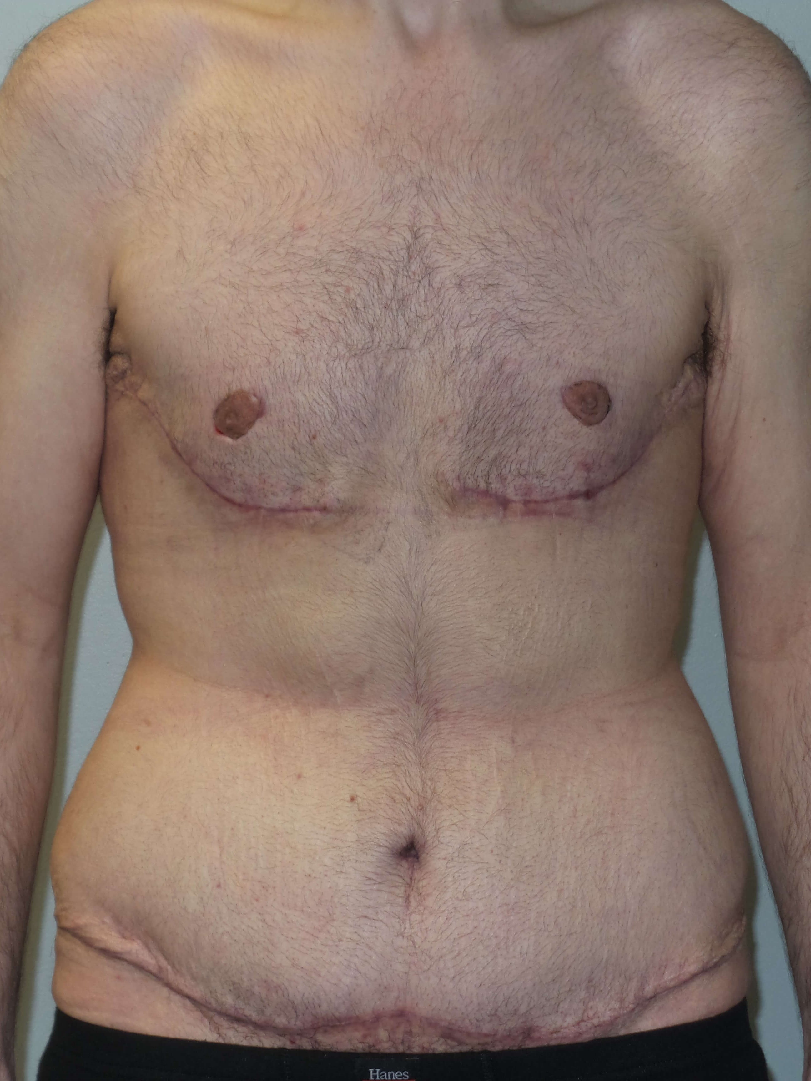 Male Chest and Abdominal Tuck After