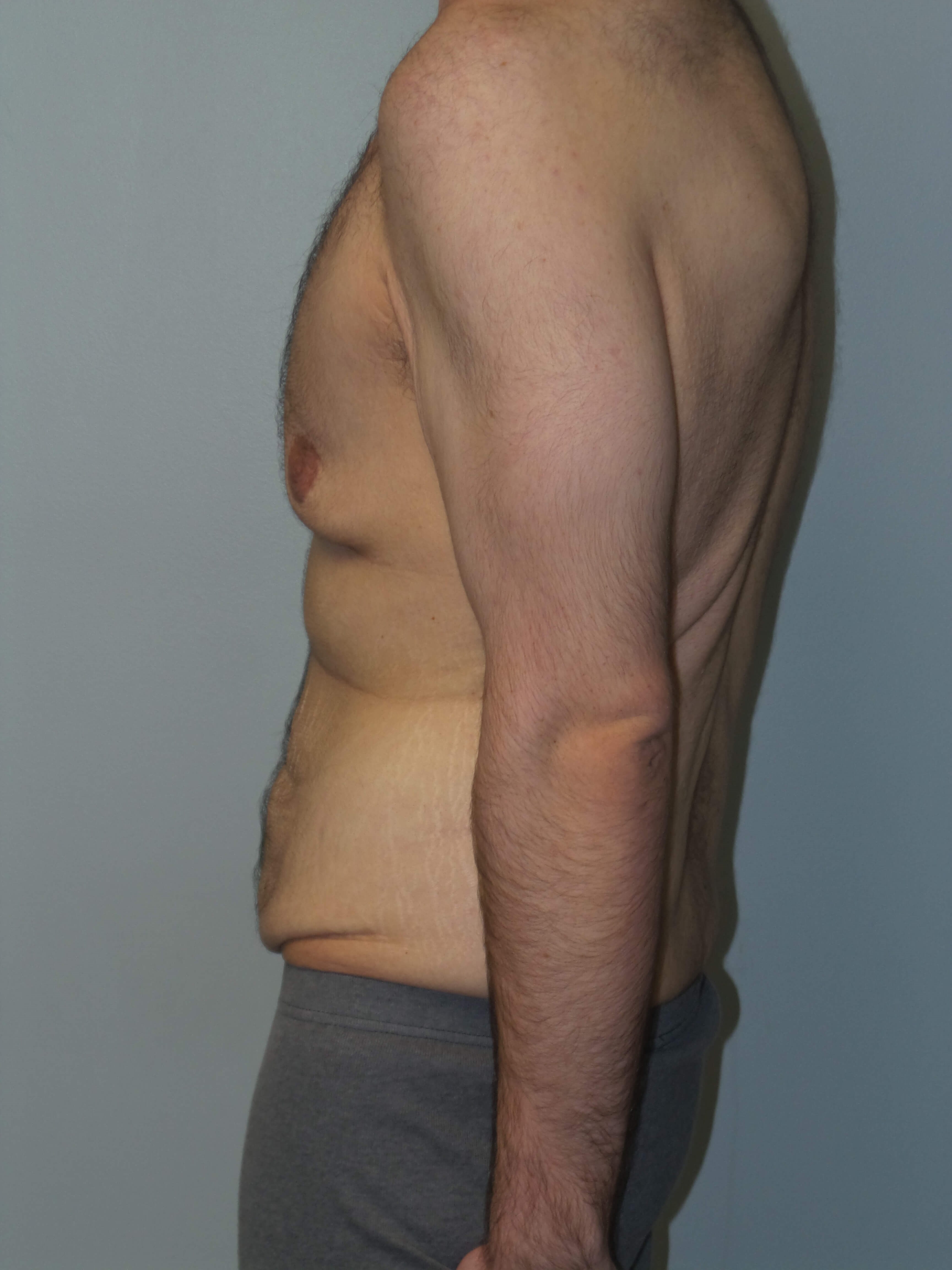 Male Chest and Abdominal Tuck Before