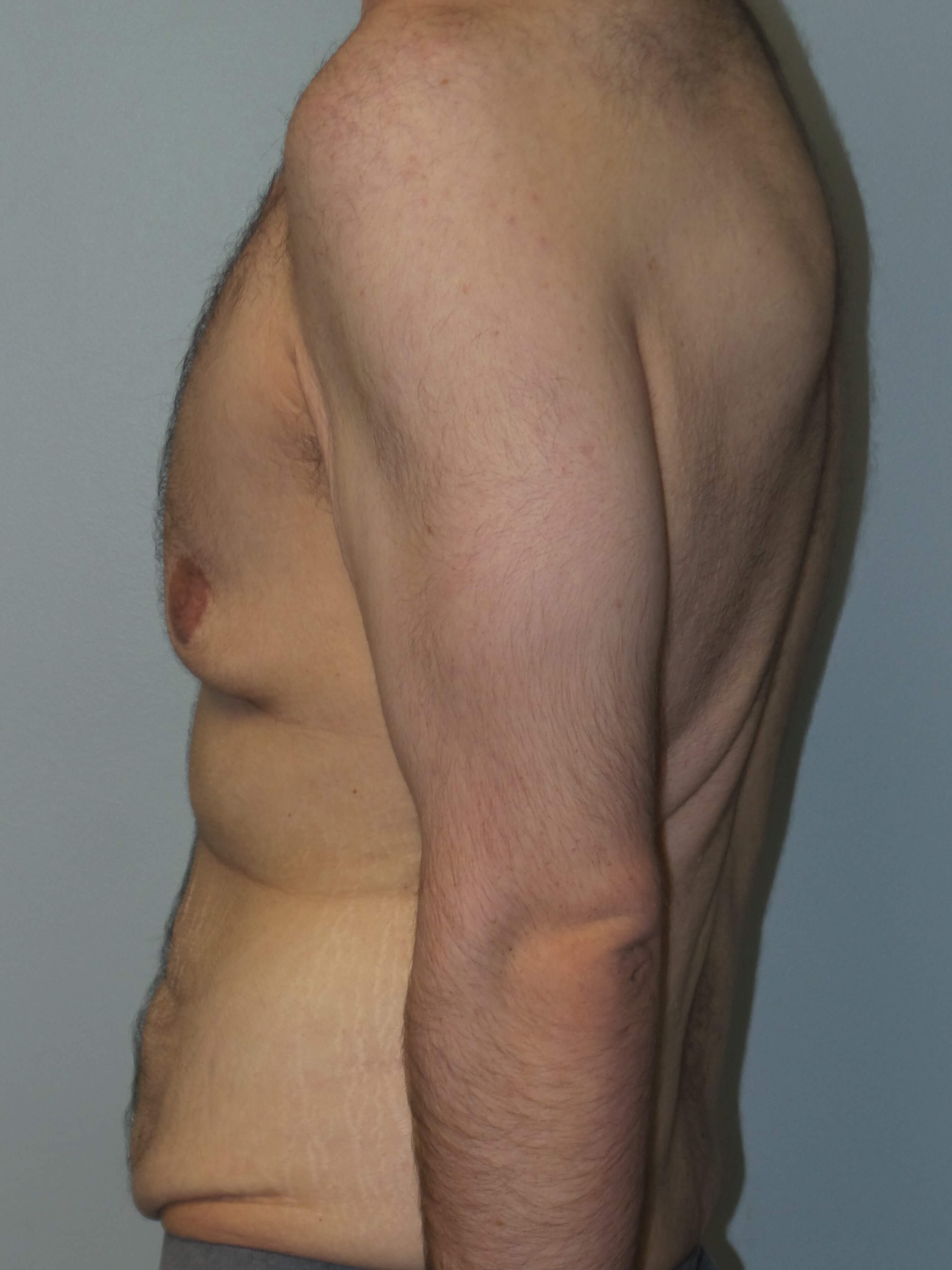 Male Chest and Abdominal Tuck Before