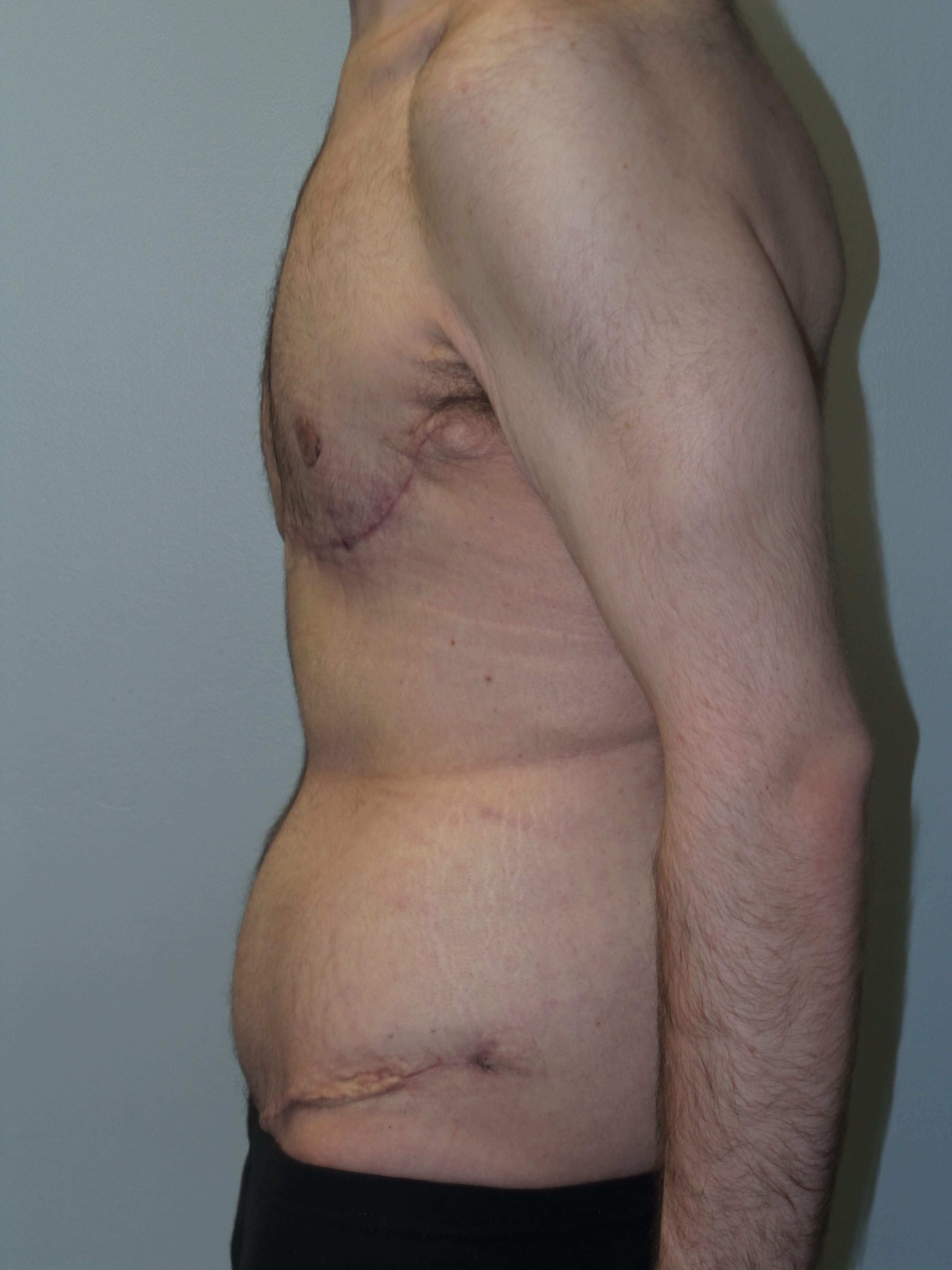 Male Chest and Abdominal Tuck After