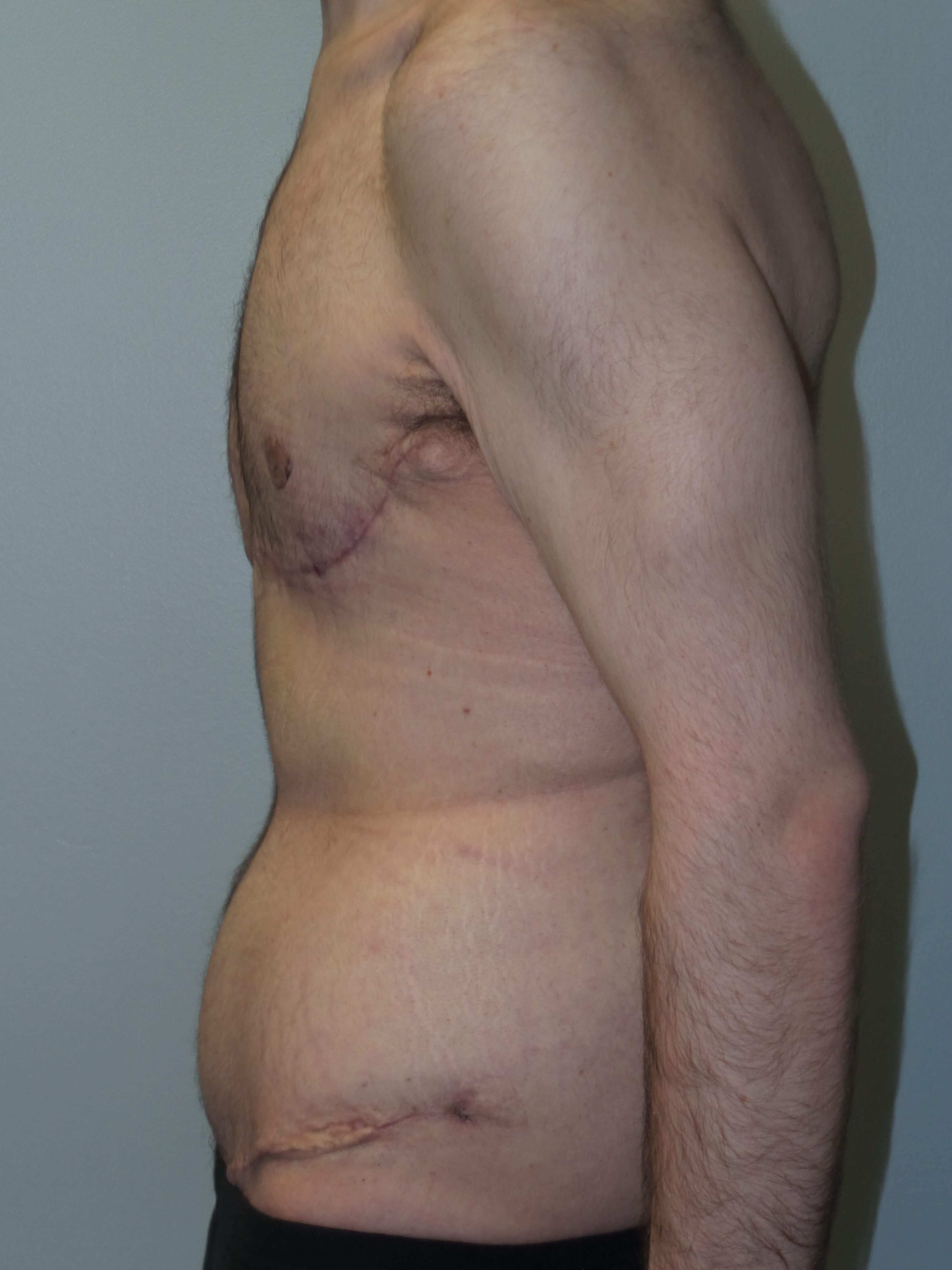 Male Chest and Abdominal Tuck After