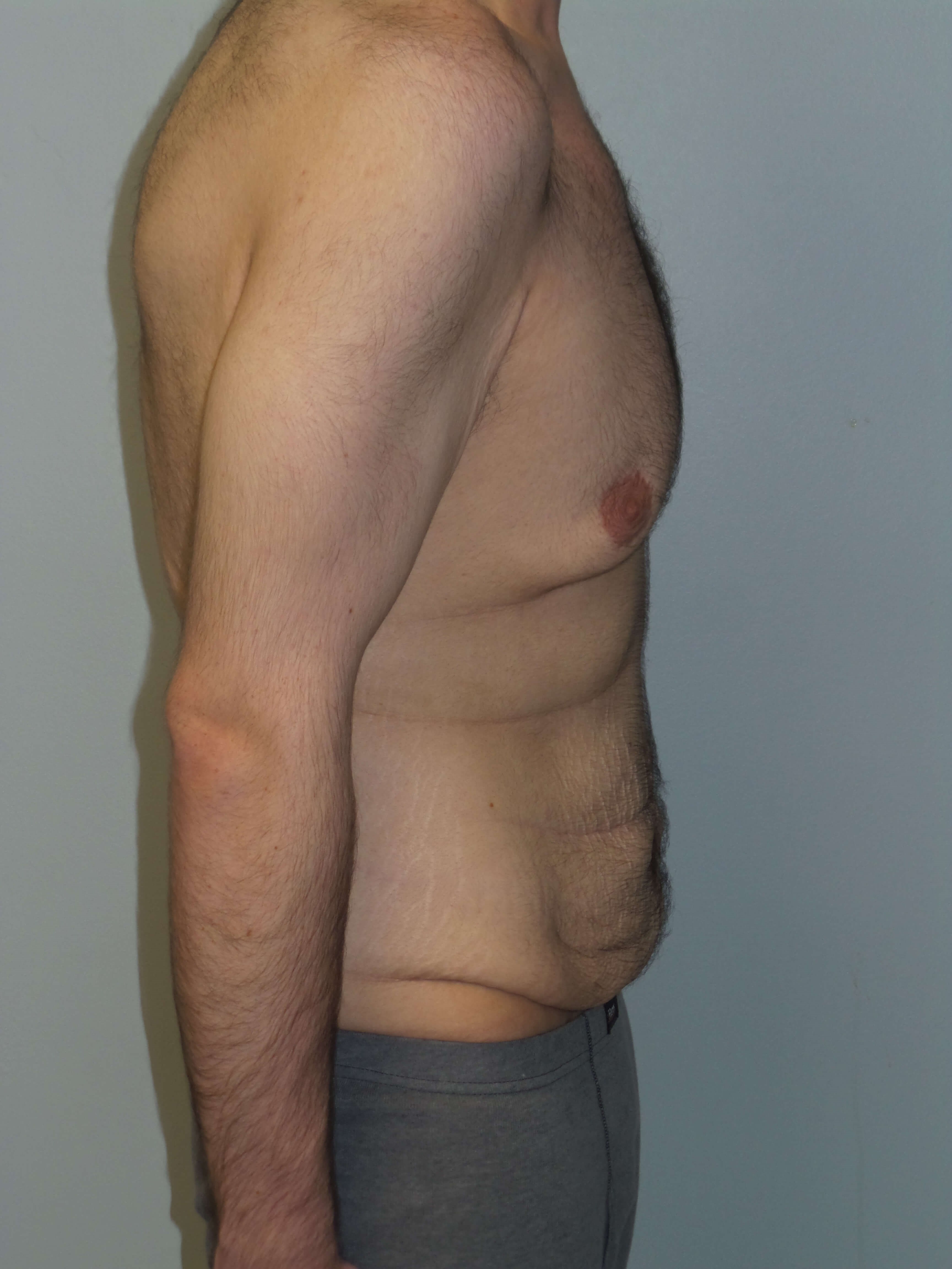 Male Chest and Abdominal Tuck Before