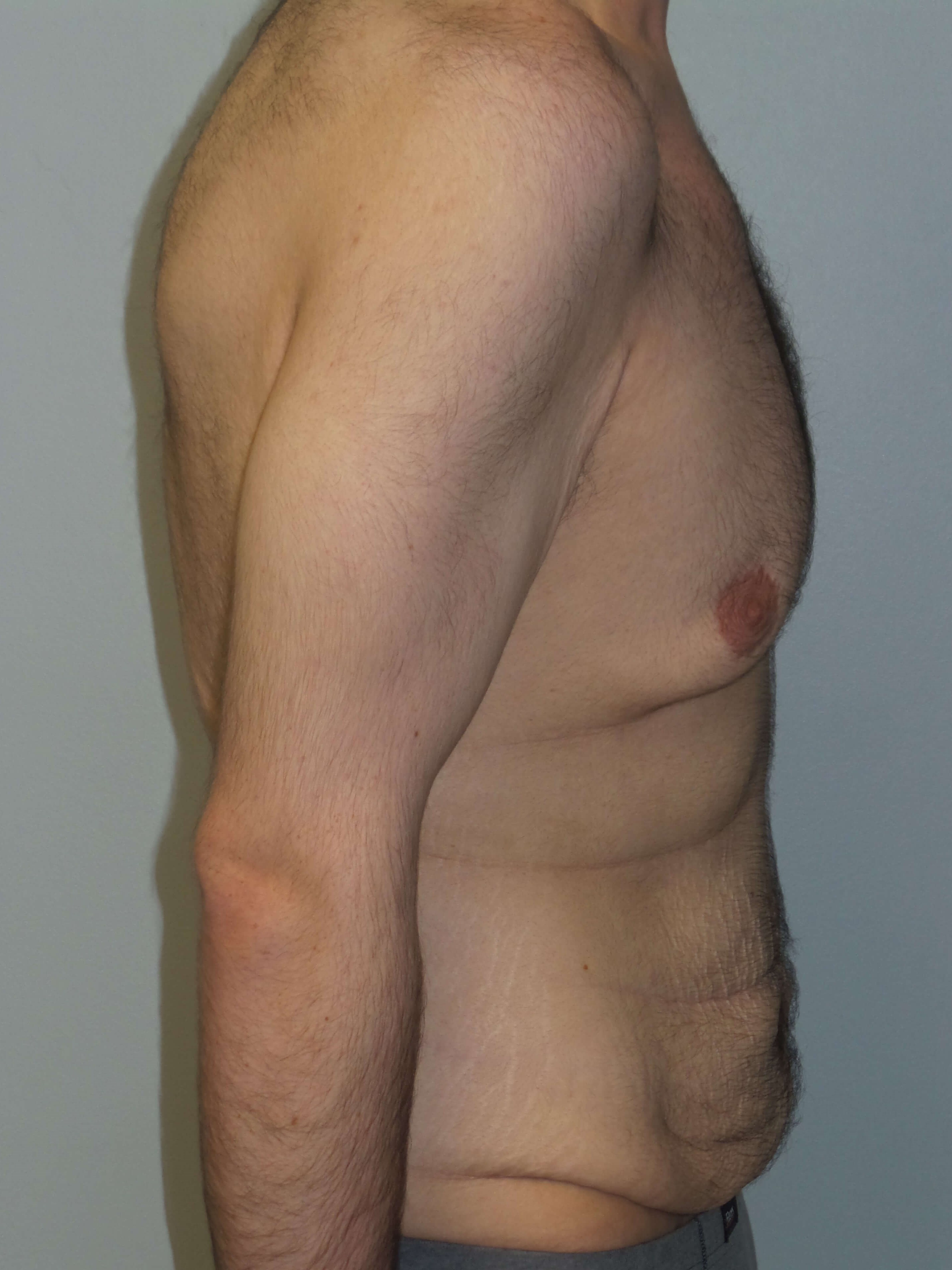 Male Chest and Abdominal Tuck Before