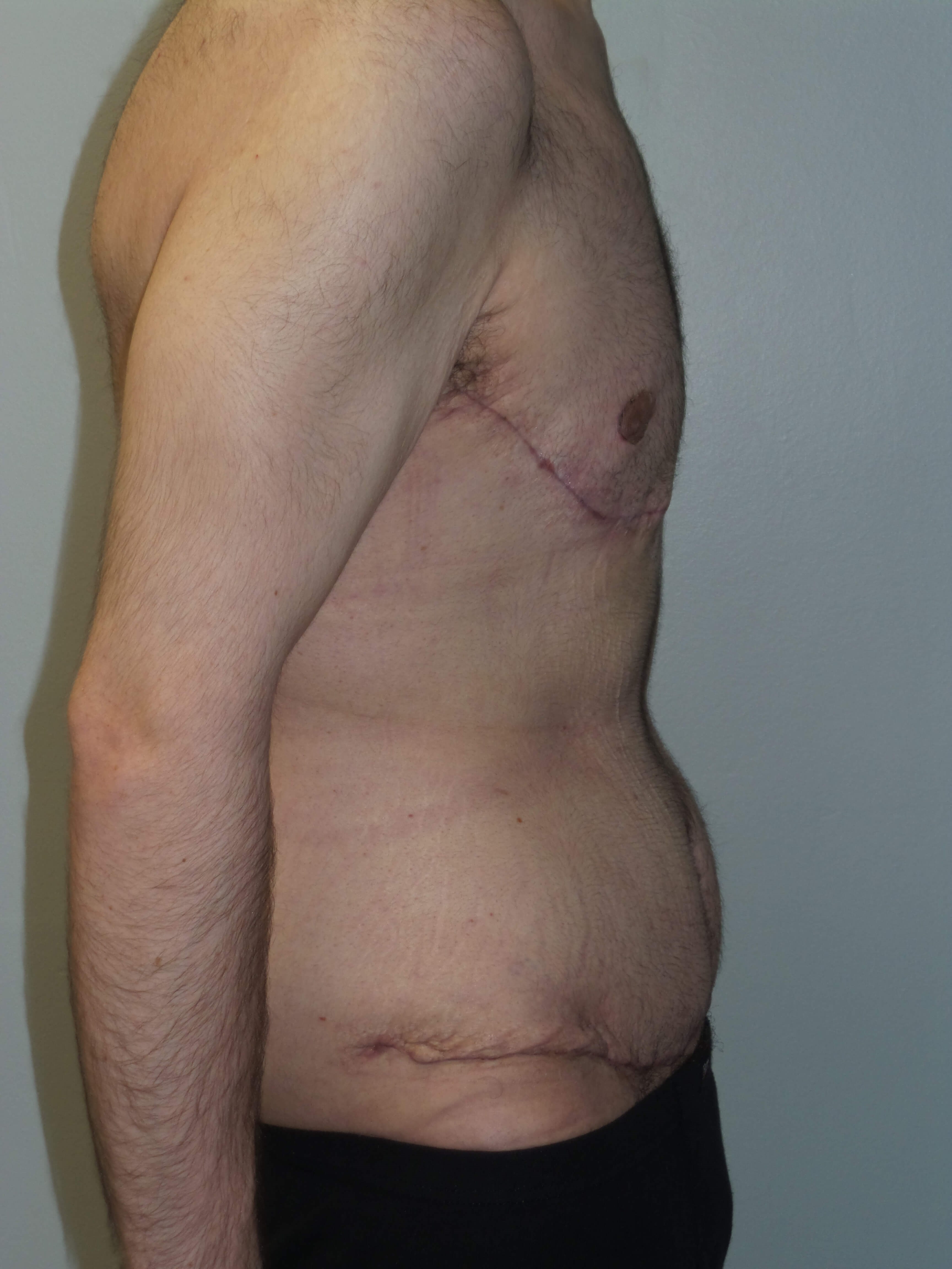 Male Chest and Abdominal Tuck After