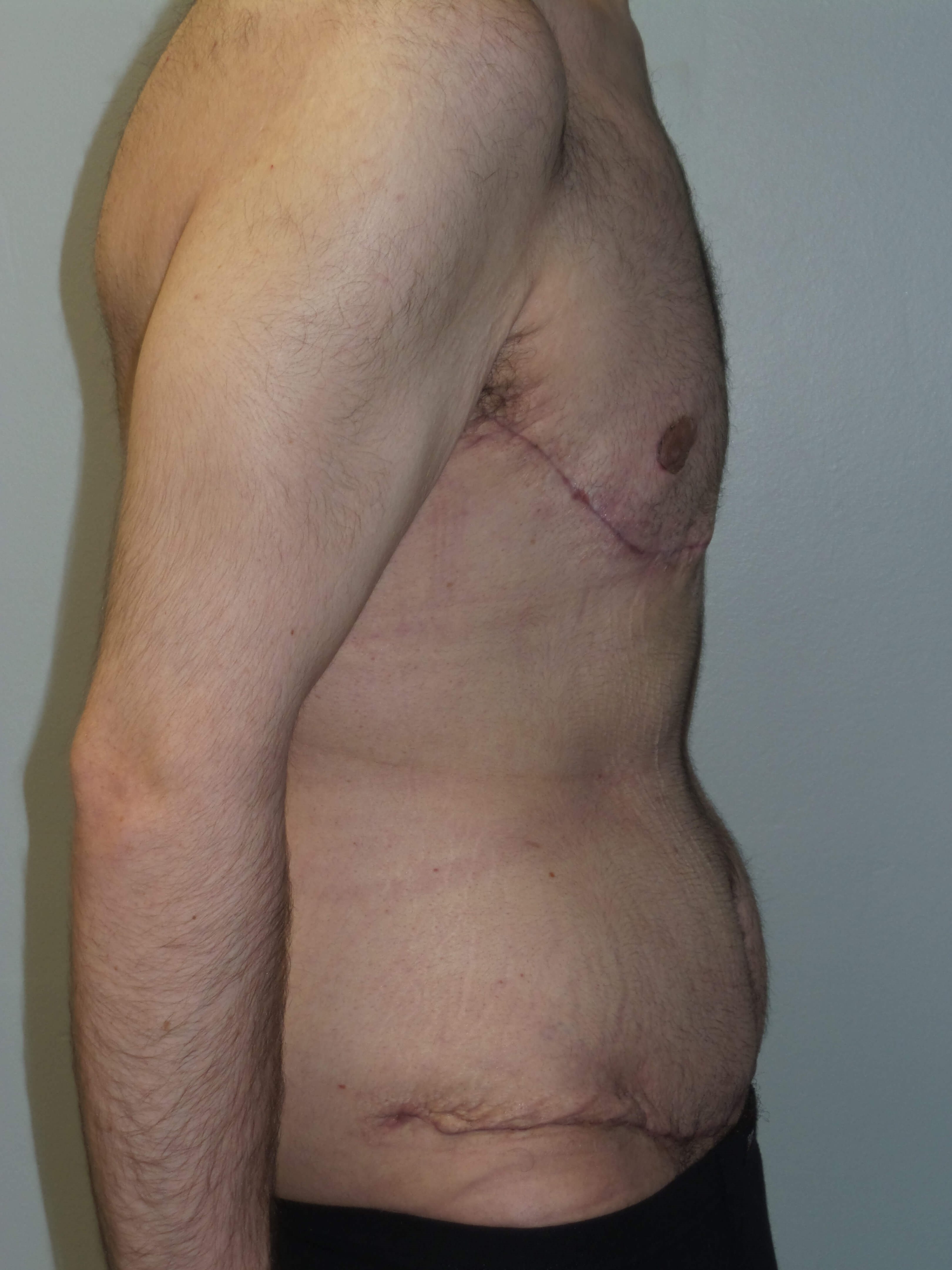 Male Chest and Abdominal Tuck After