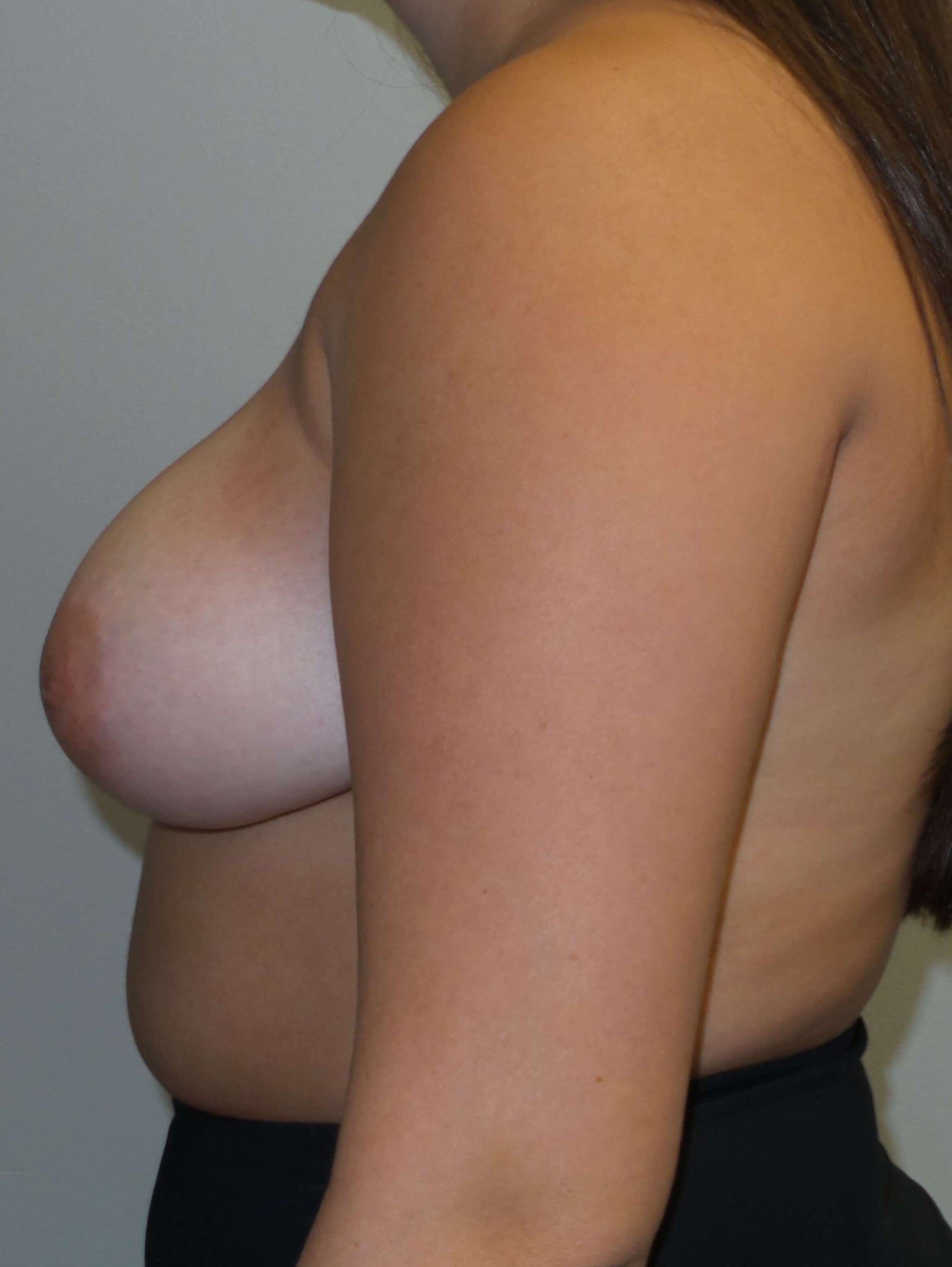 Breast Lift Reduction Before