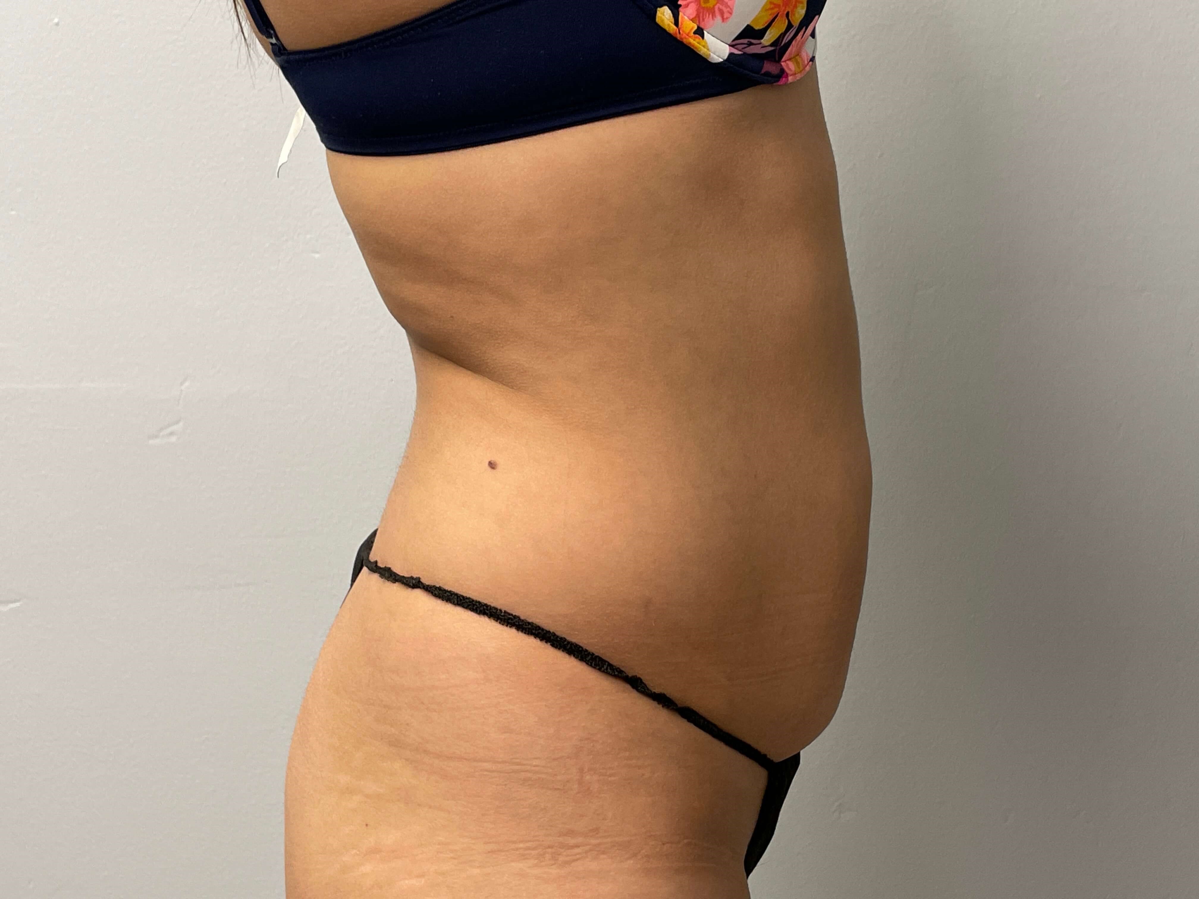 Woman has Liposuction Before