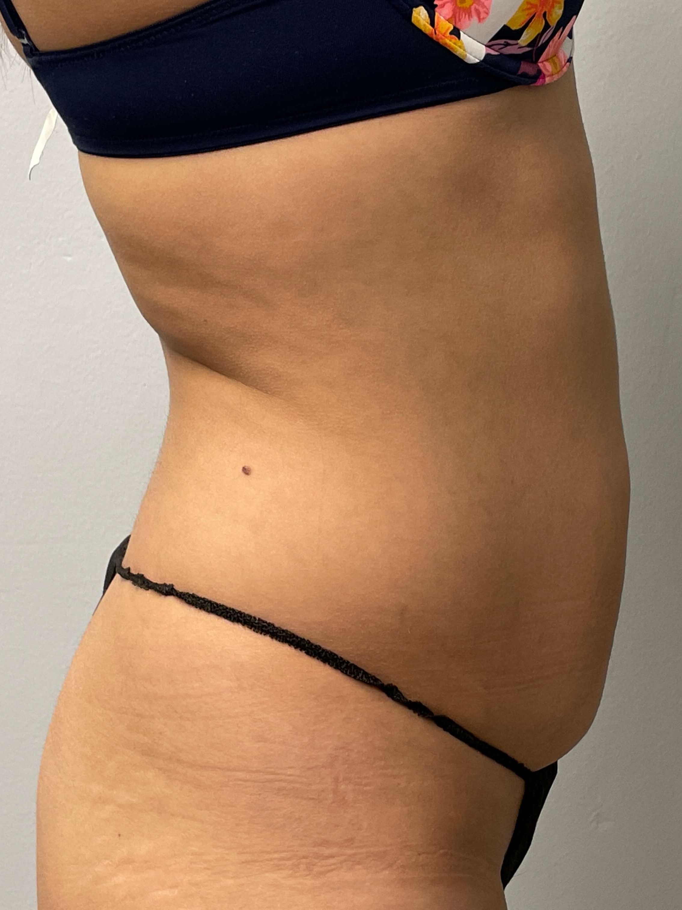 Woman has Liposuction Before