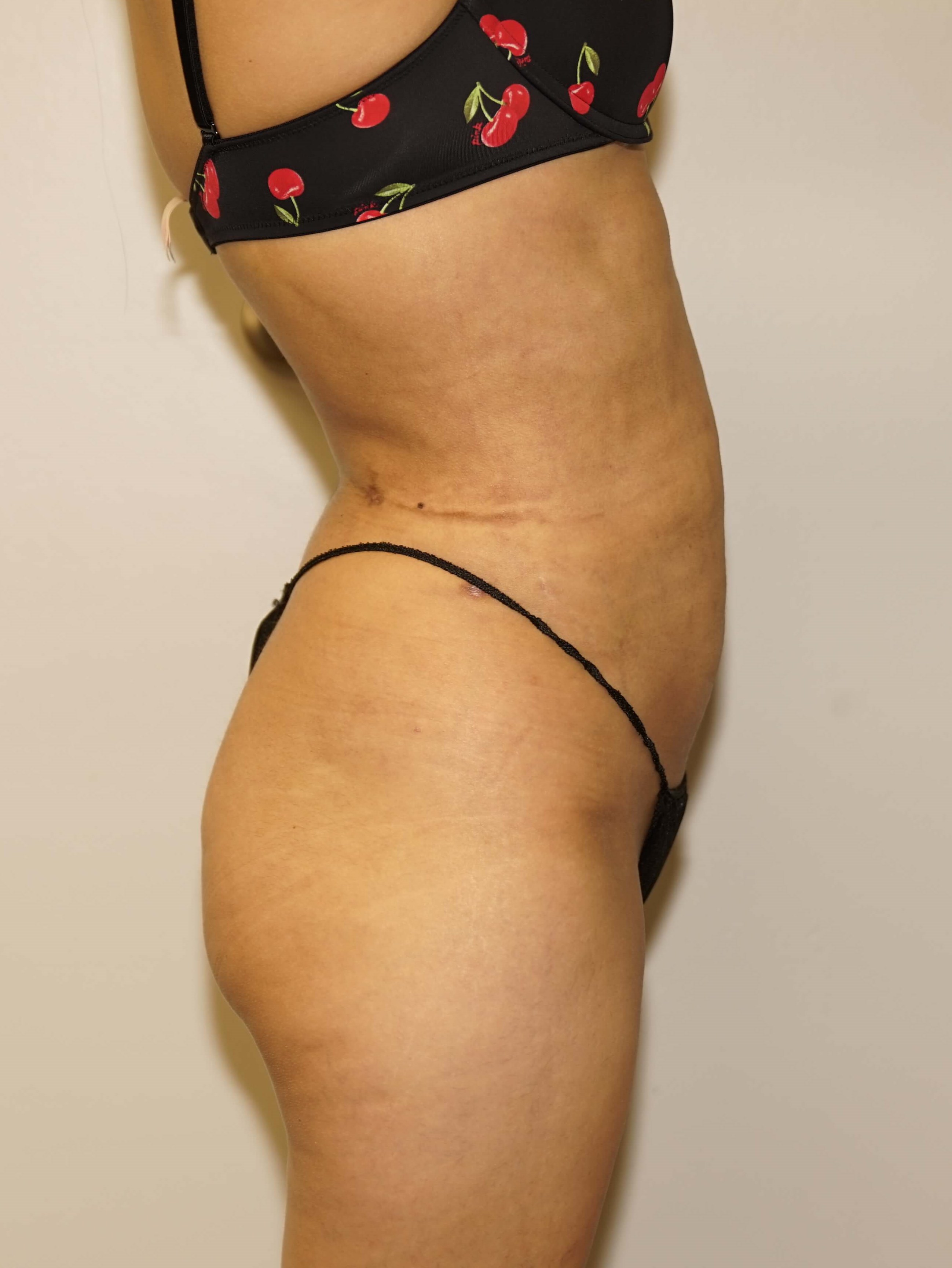 Woman has Liposuction After