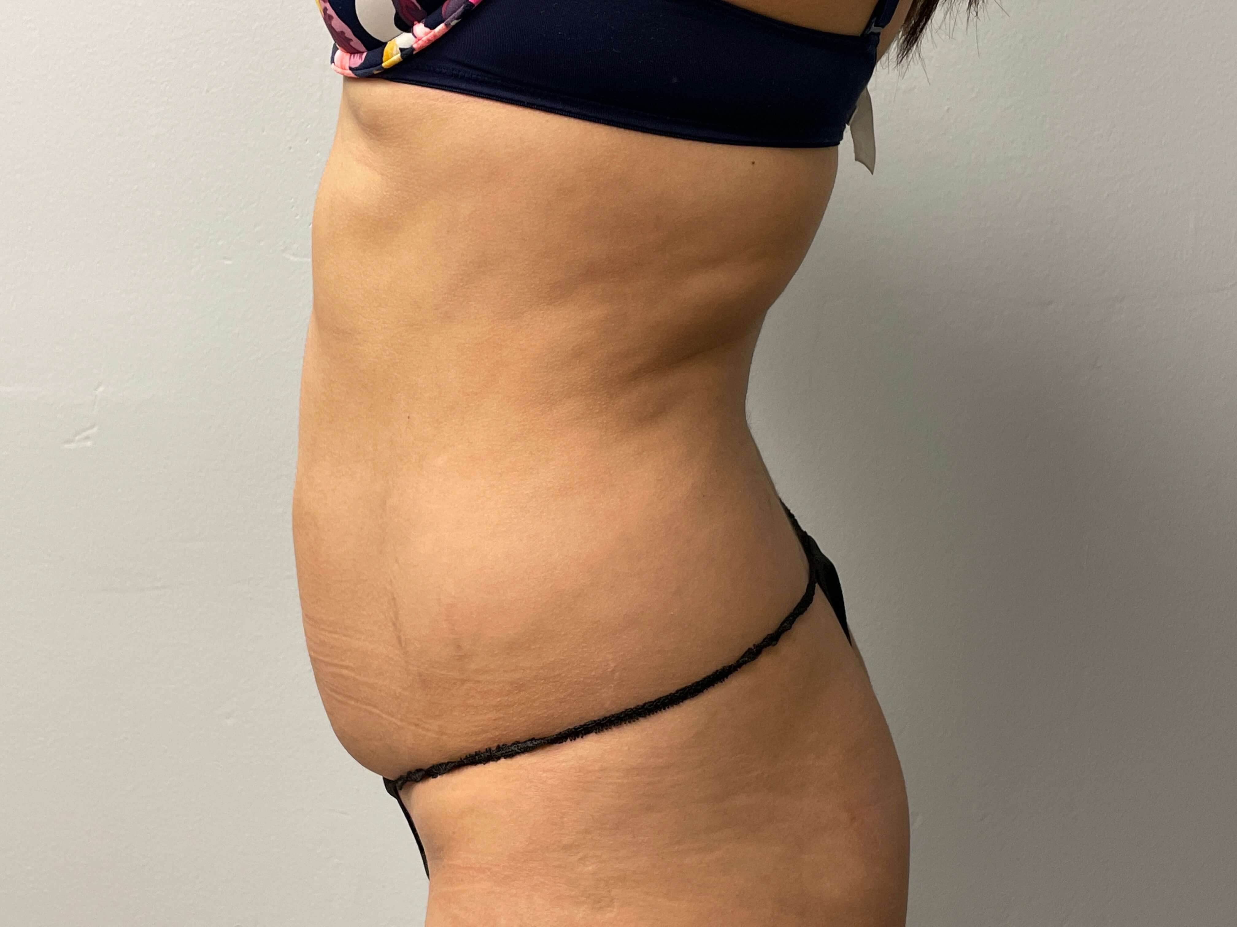 Woman has Liposuction Before