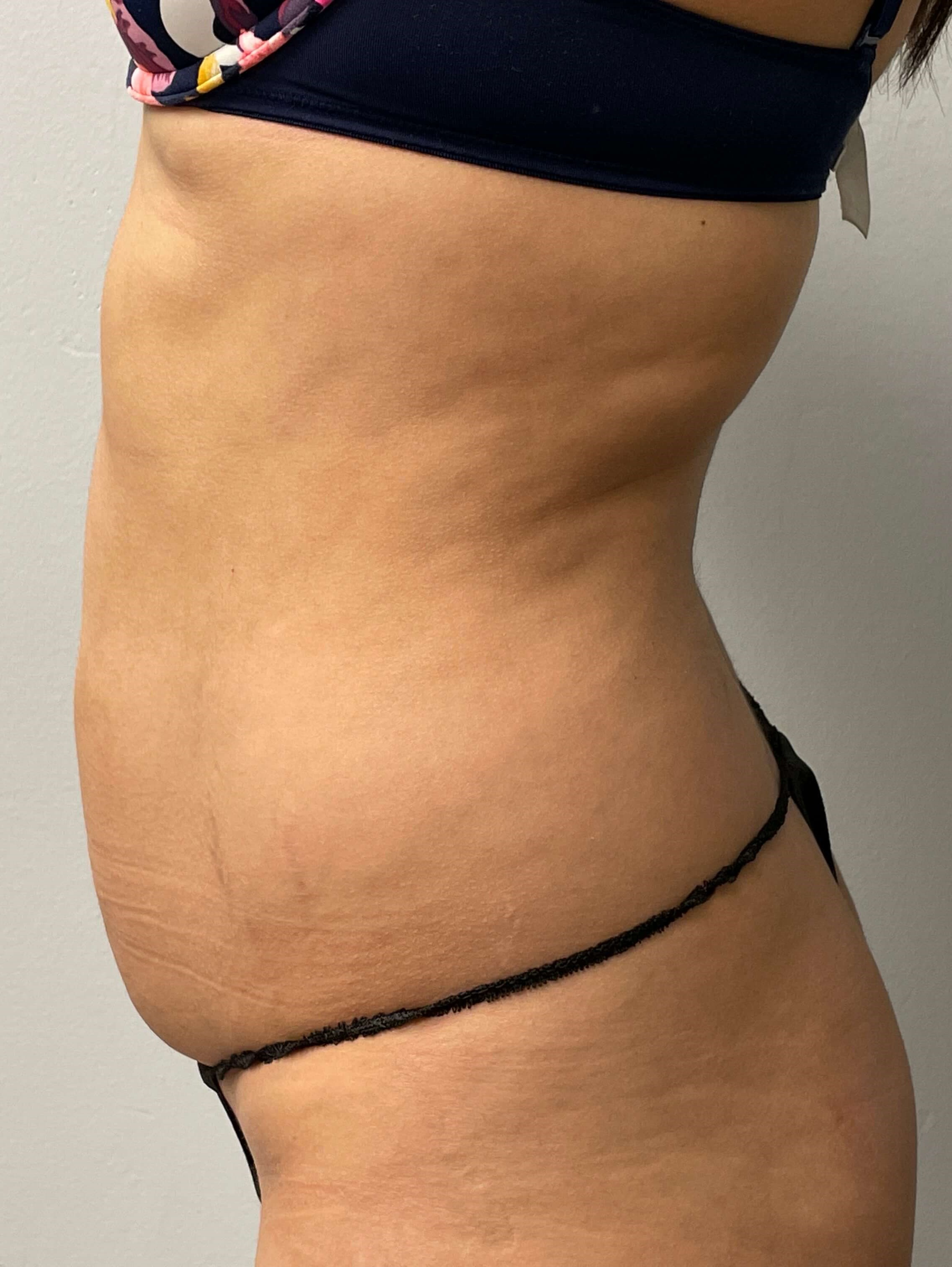 Woman has Liposuction Before