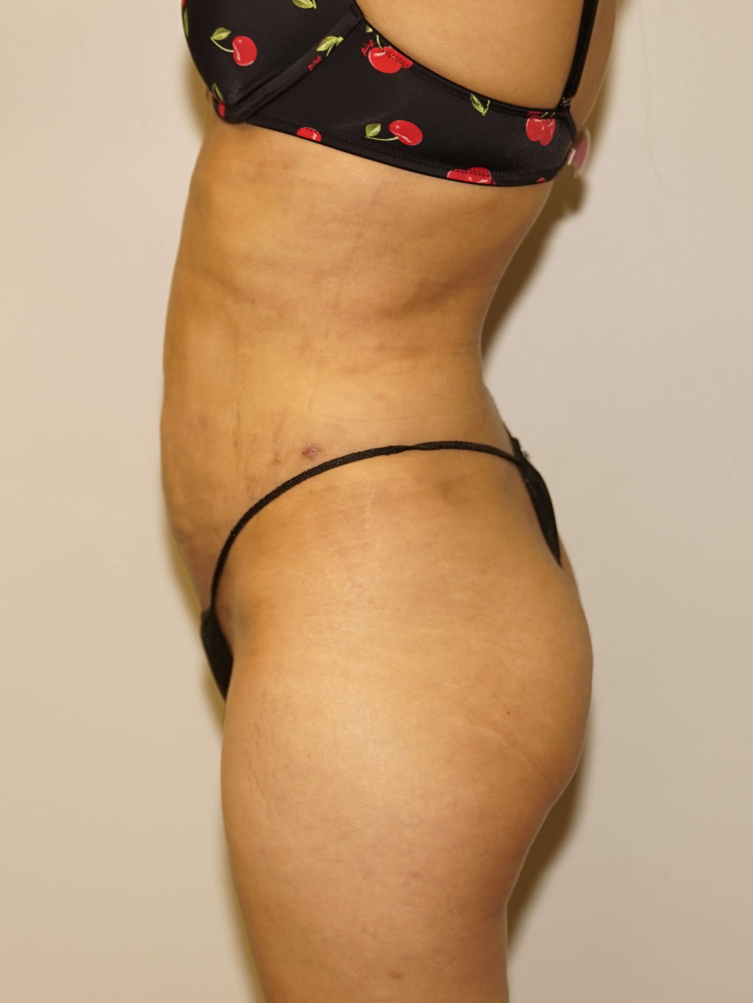 Woman has Liposuction After