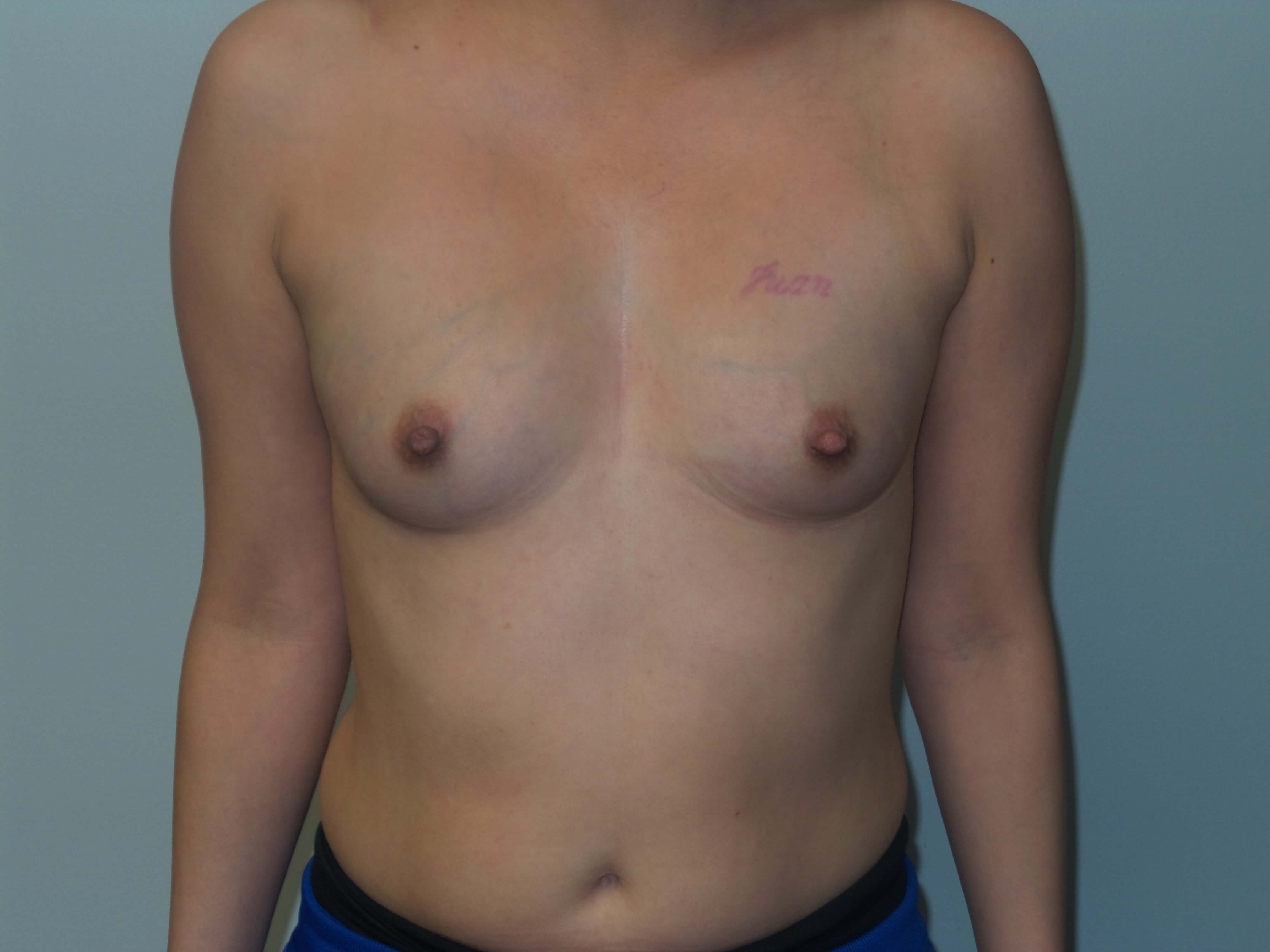 400cc Silicone Breast Implants Before