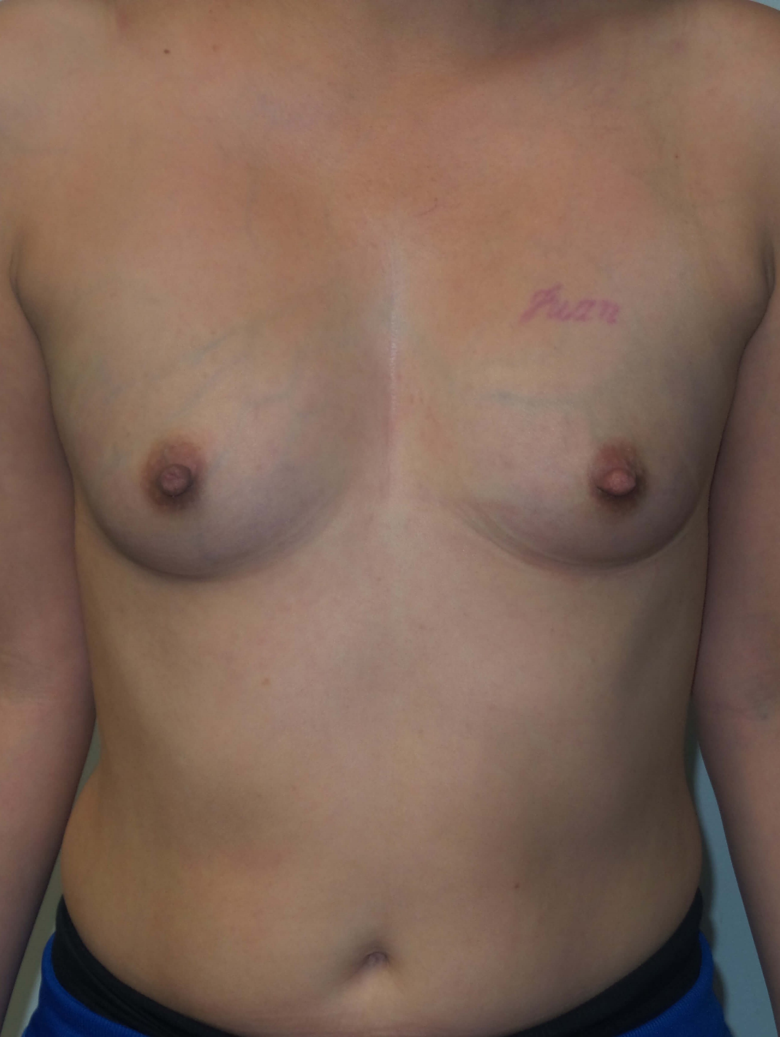 400cc Silicone Breast Implants Before
