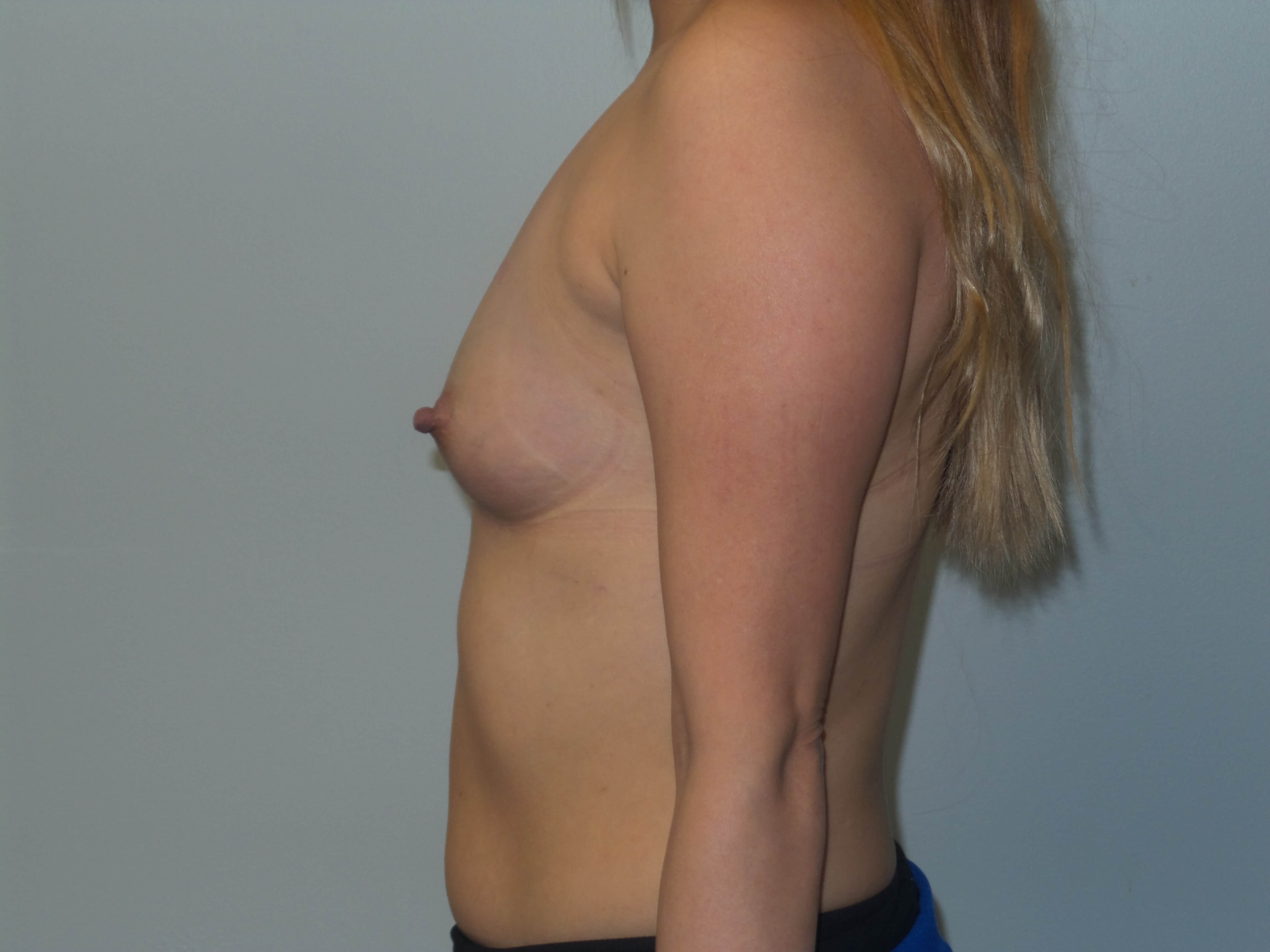 400cc Silicone Breast Implants Before