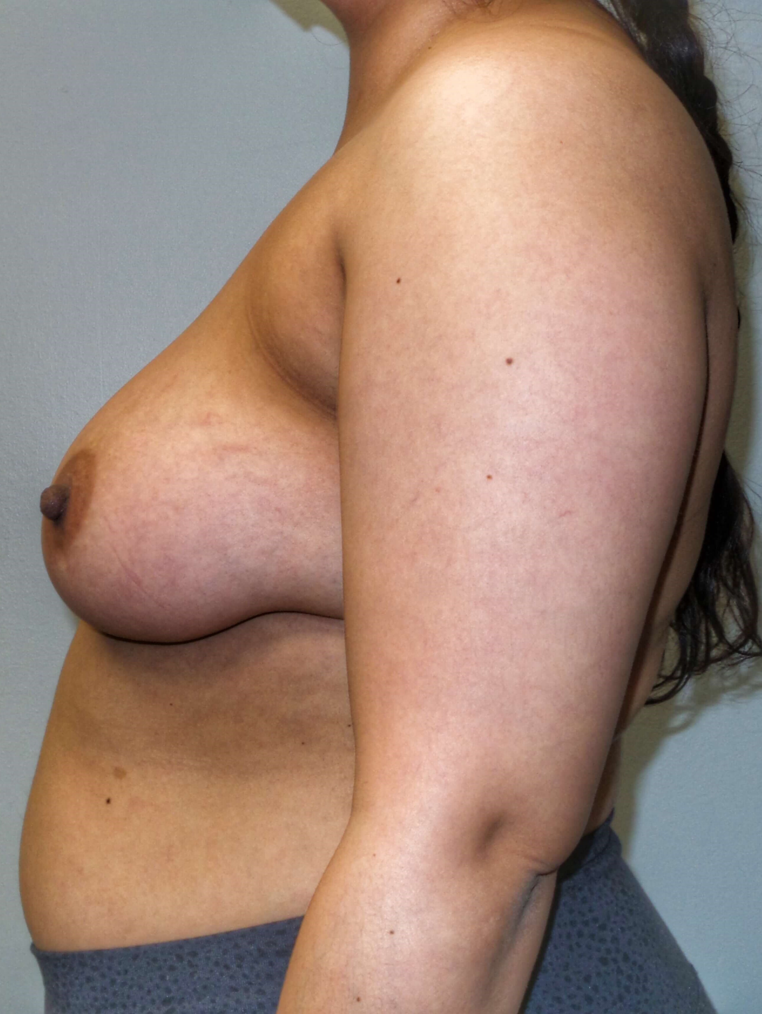 Woman has Breast Lift + Aug Before