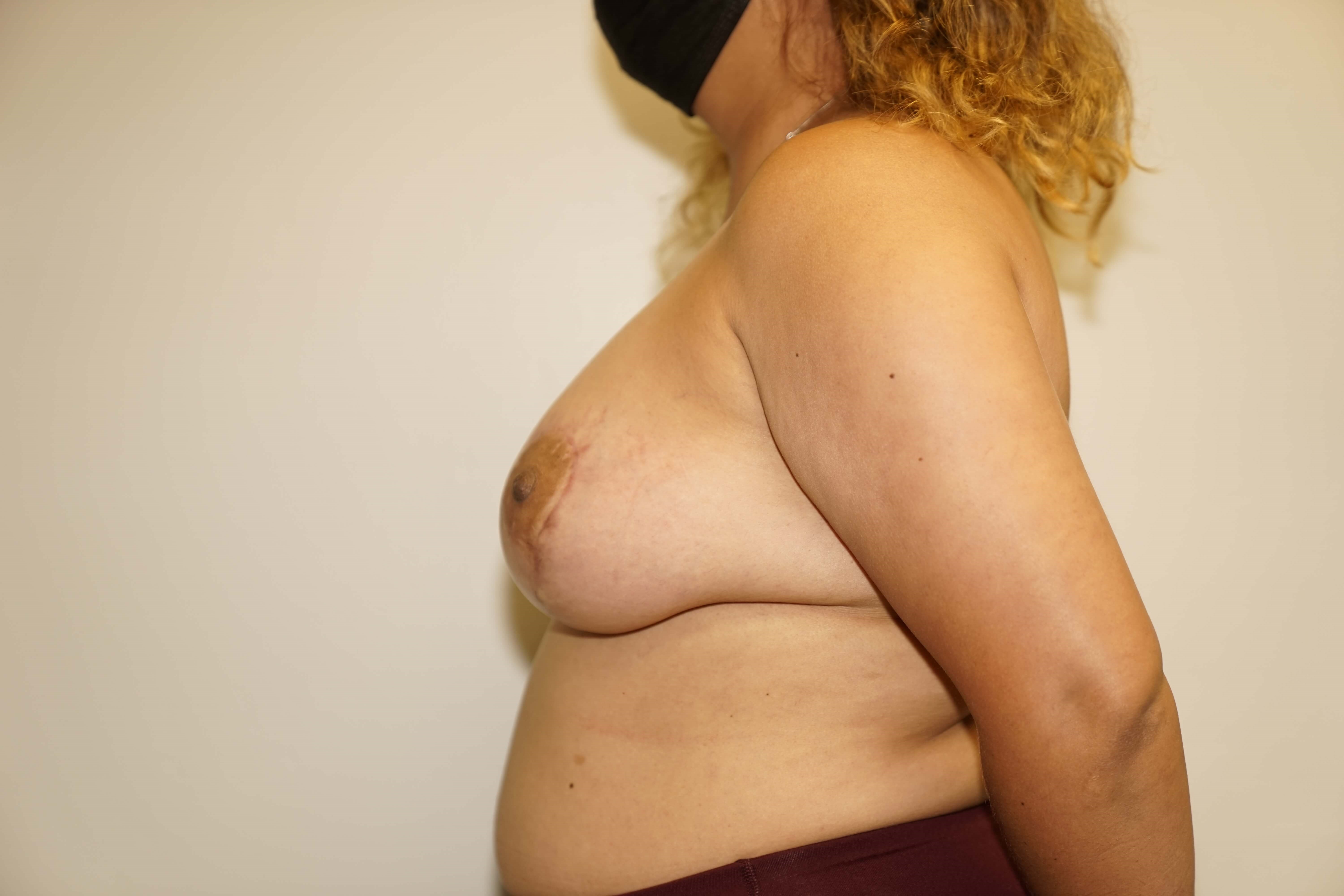 Woman has Breast Lift + Aug After