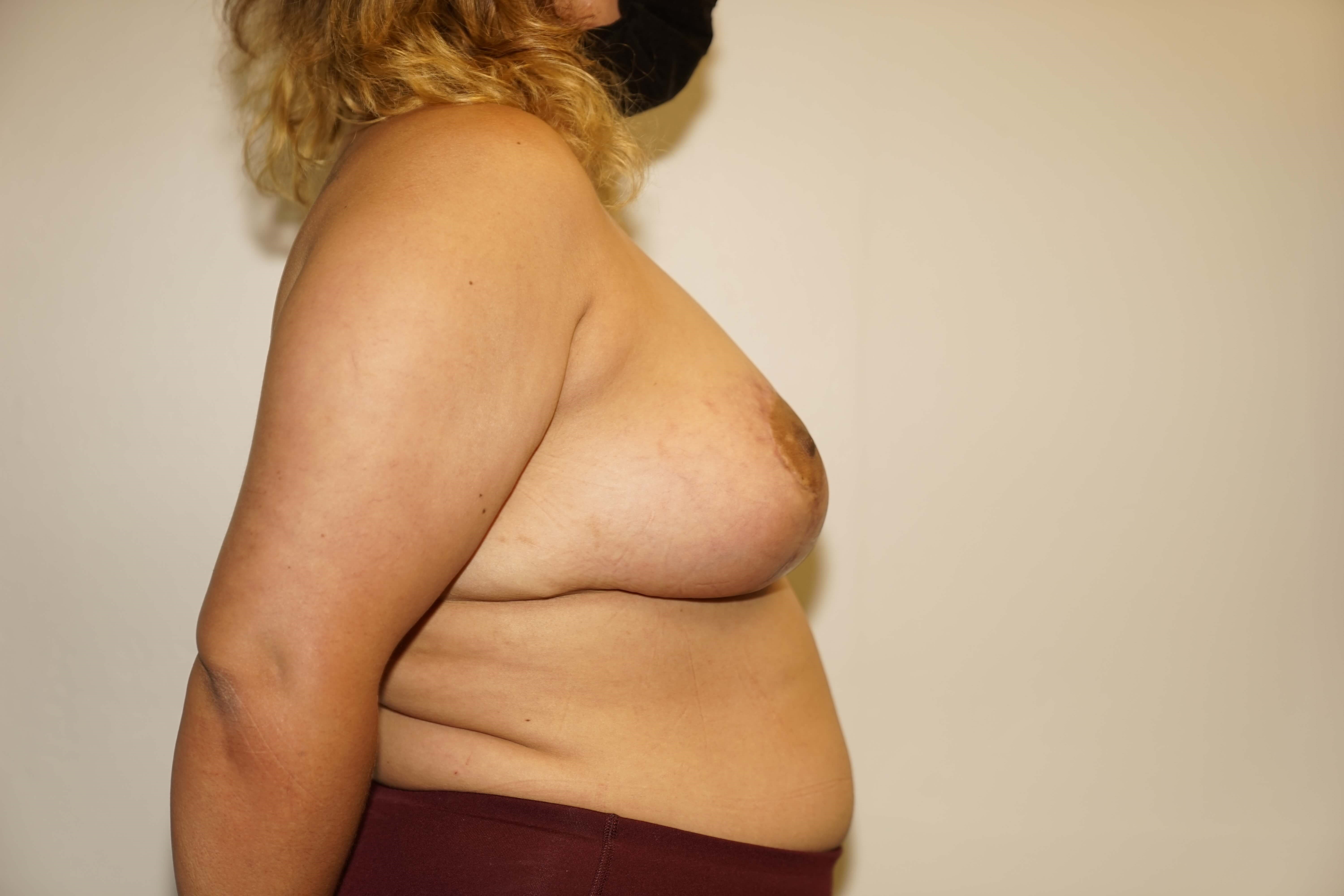 Woman has Breast Lift + Aug After