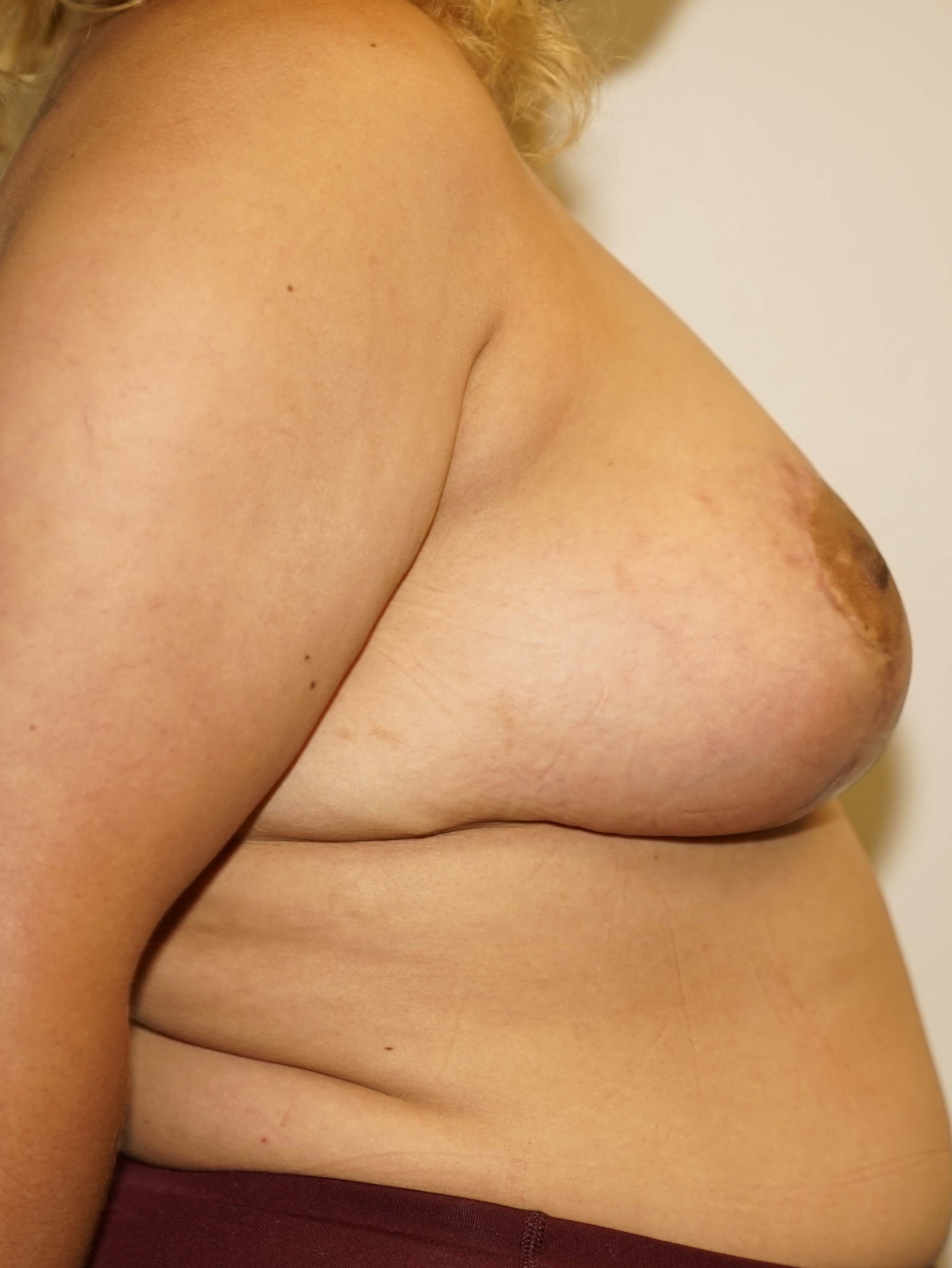 Woman has Breast Lift + Aug After