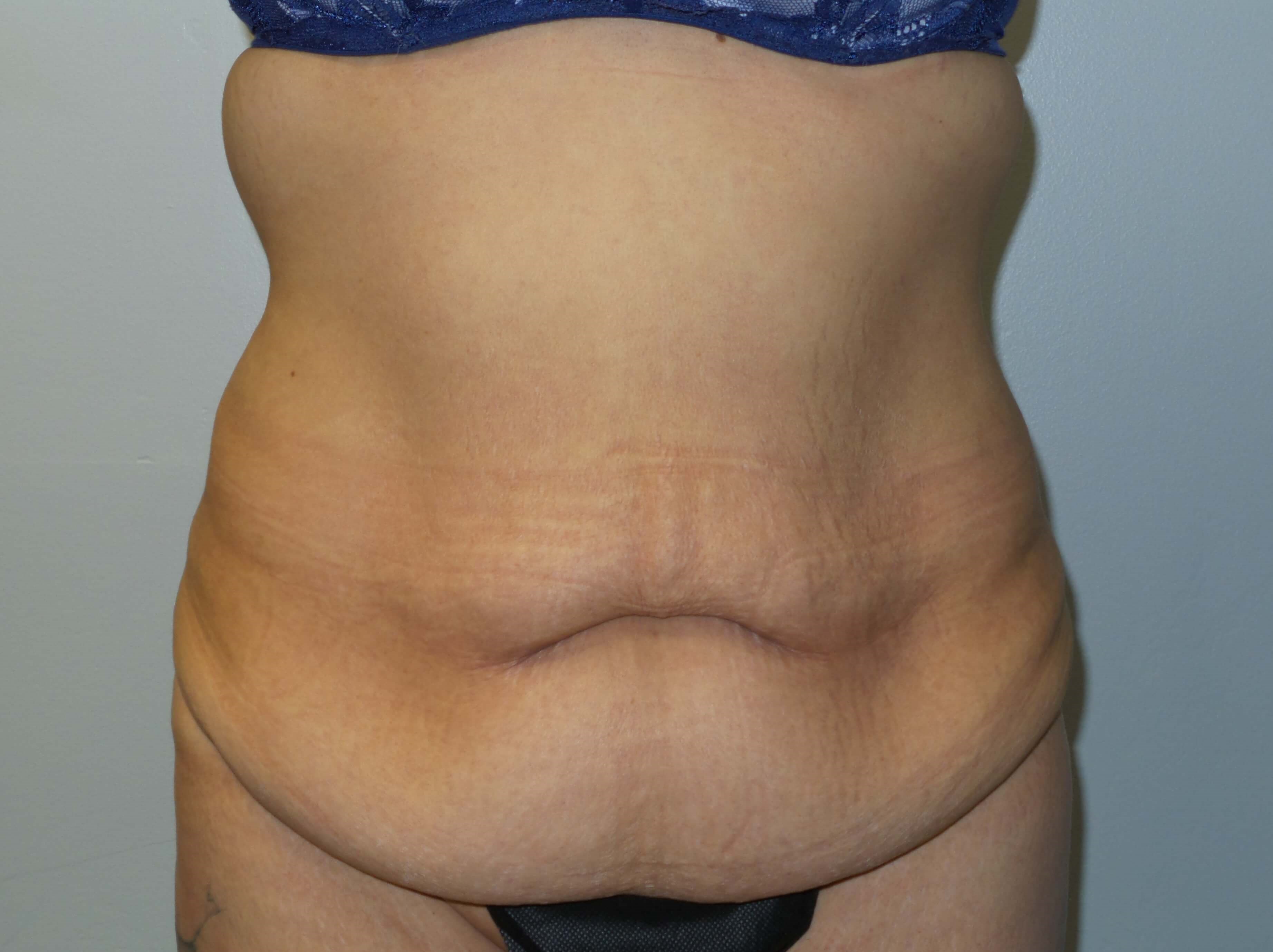 Woman has Tummy Tuck + Lipo Before
