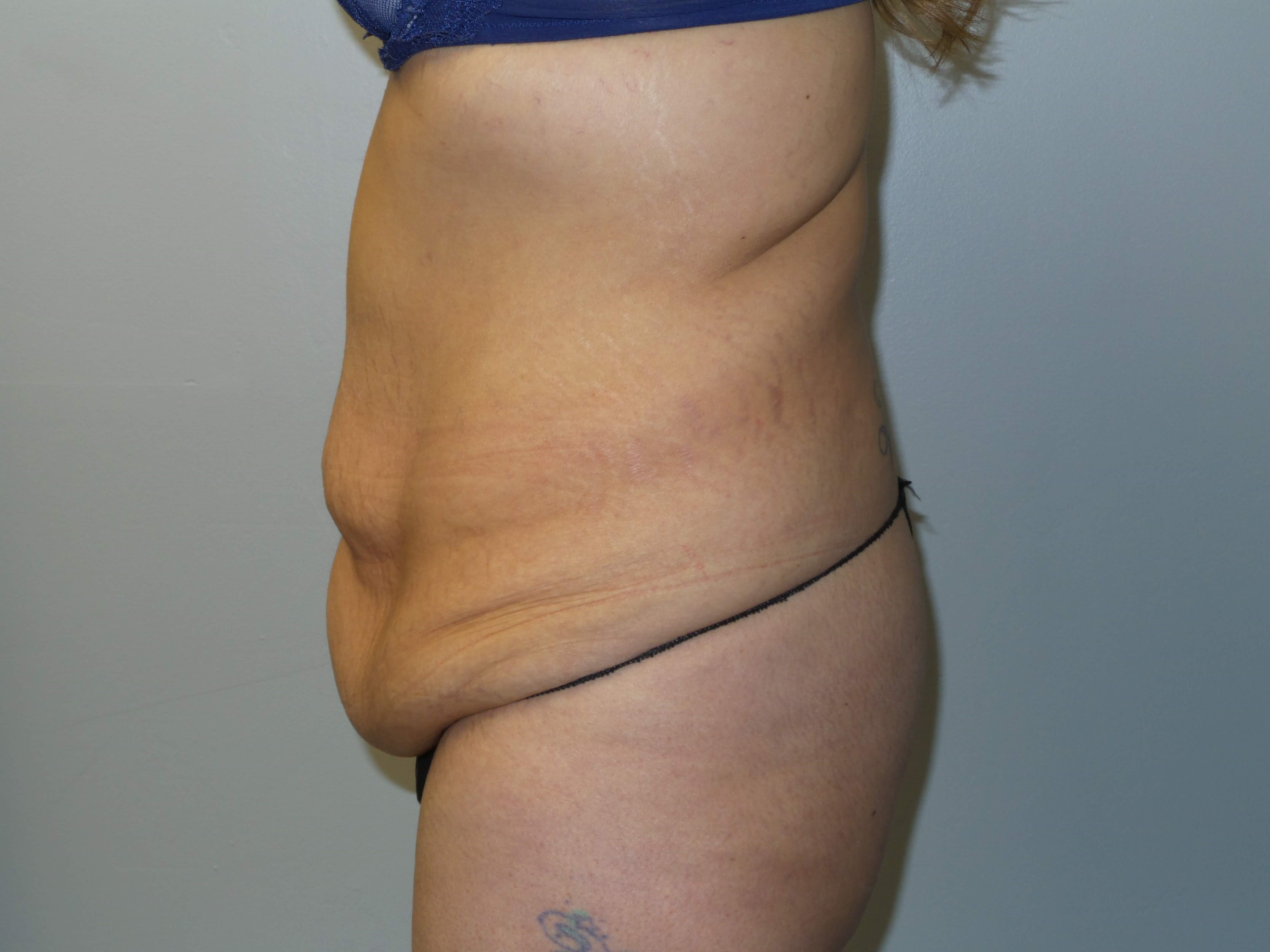 Woman has Tummy Tuck + Lipo Before