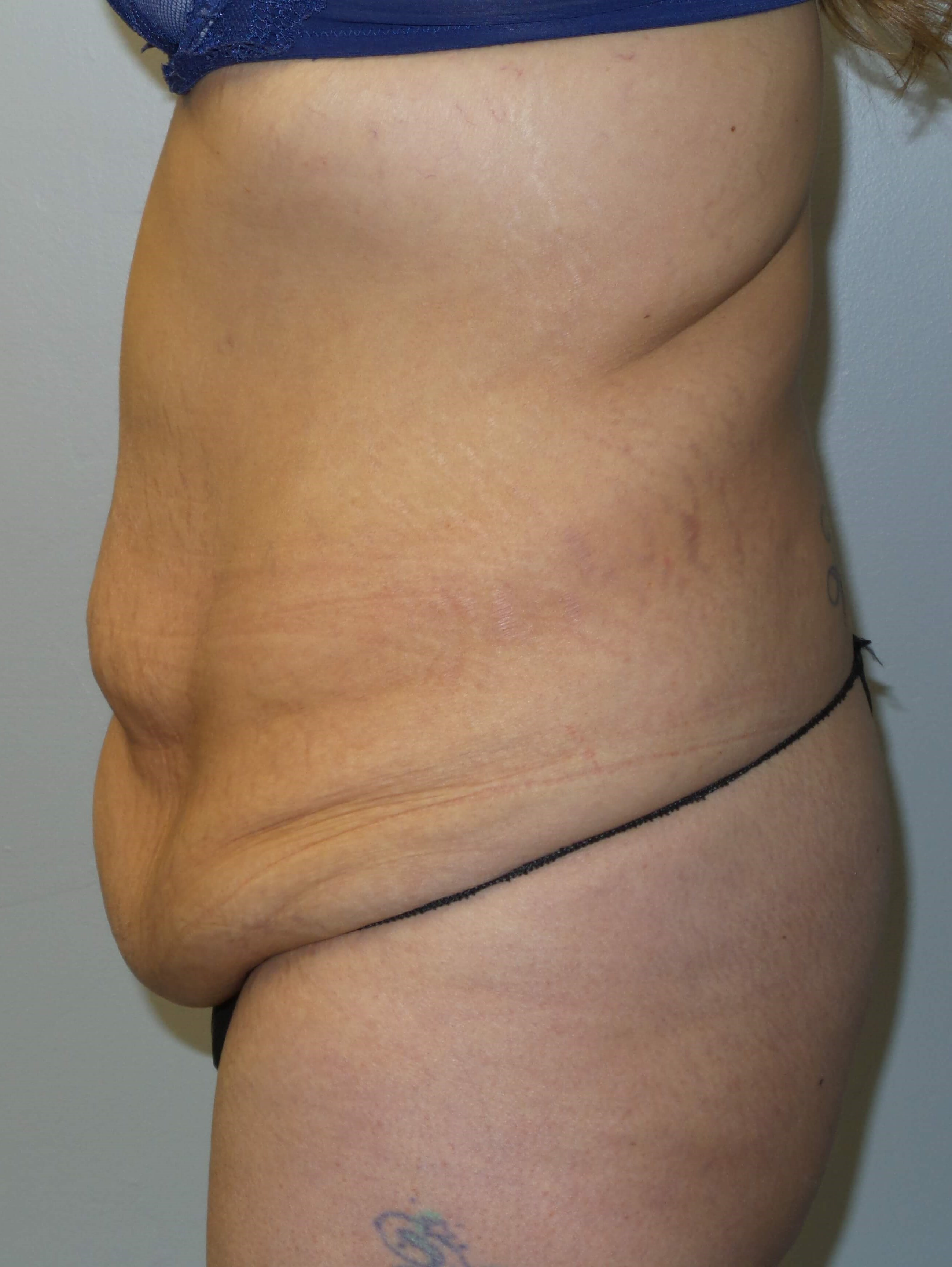Woman has Tummy Tuck + Lipo Before
