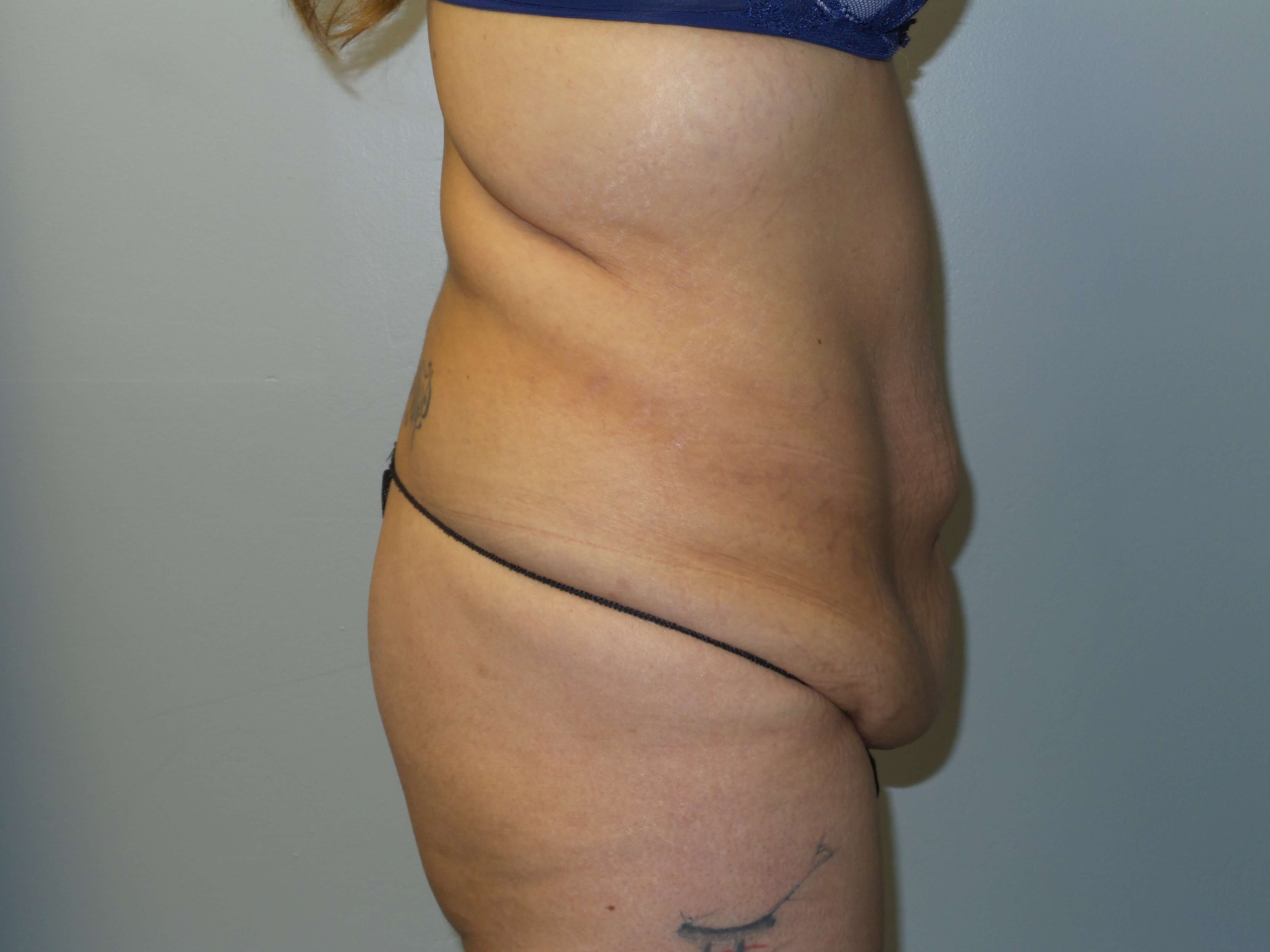 Woman has Tummy Tuck + Lipo Before