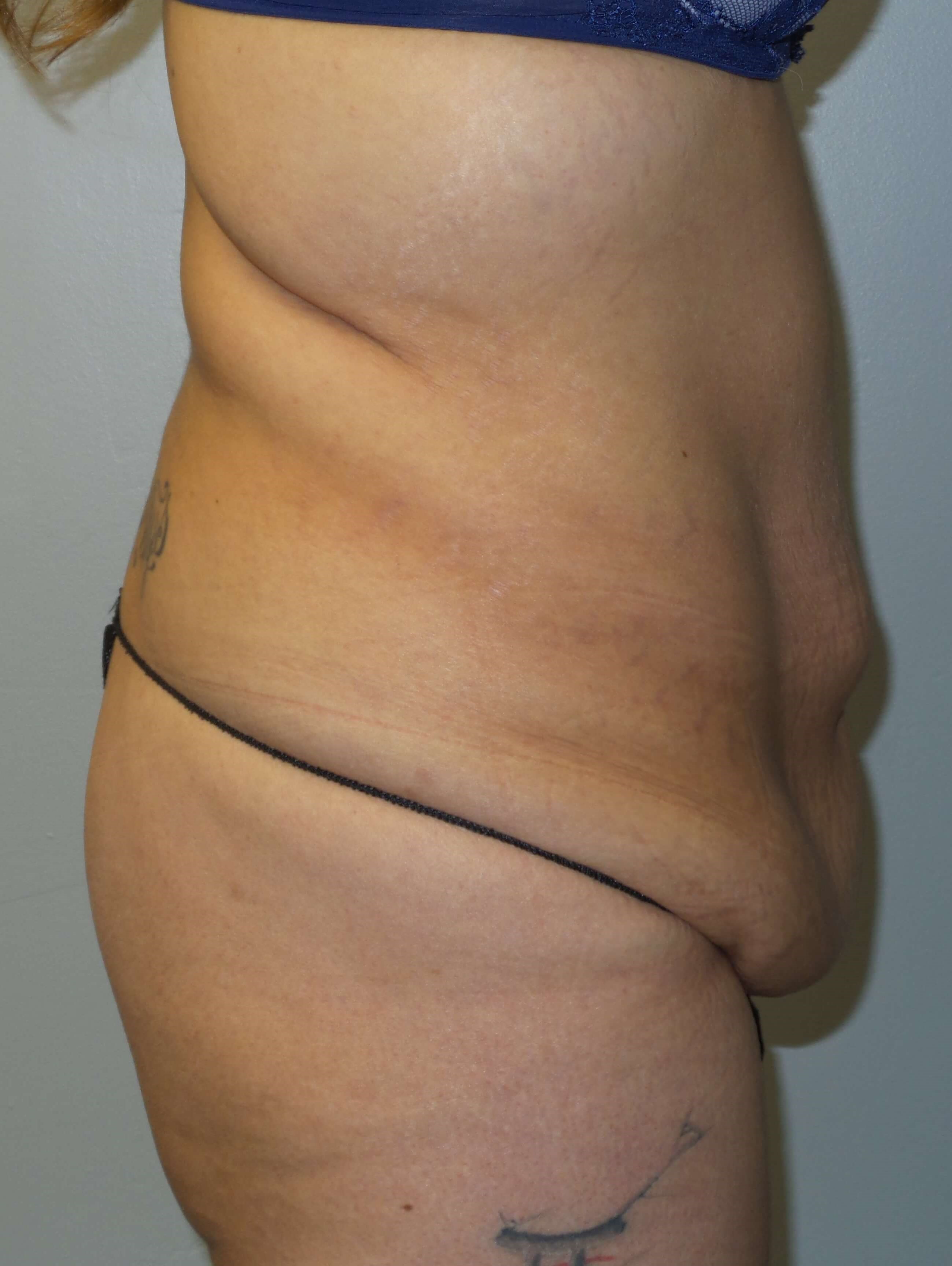 Woman has Tummy Tuck + Lipo Before