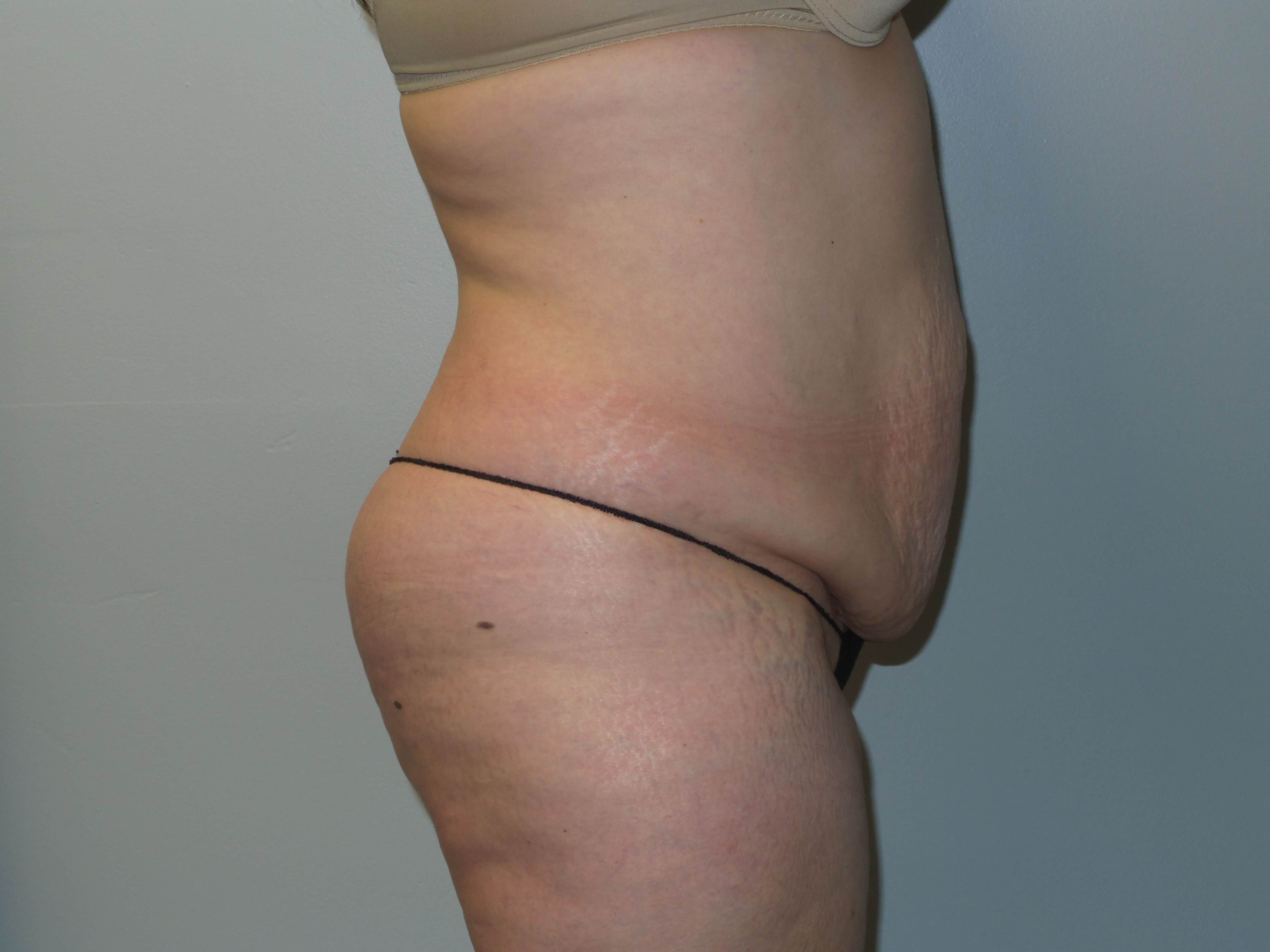Woman has Tummy Tuck + Lipo Before