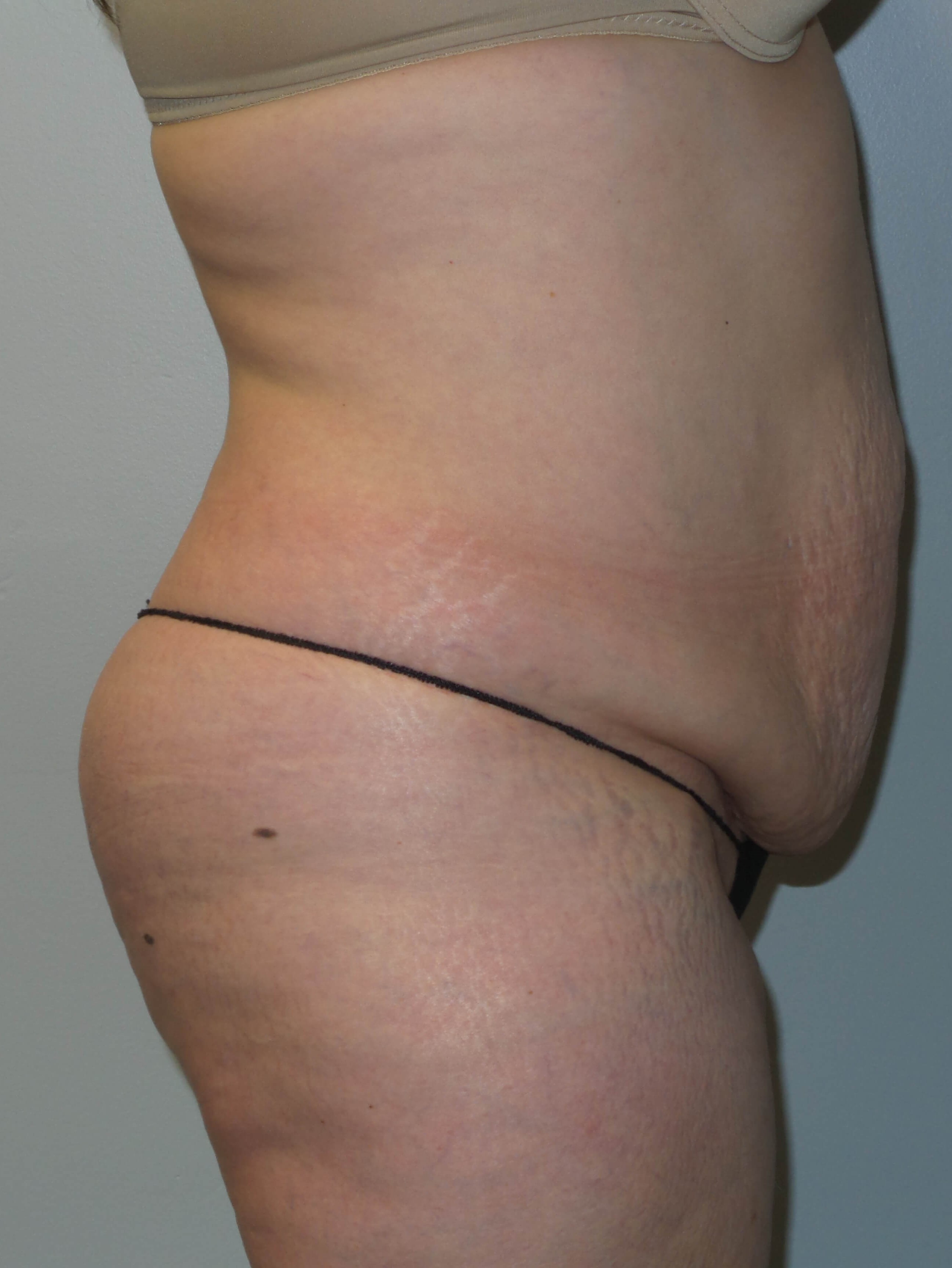 Woman has Tummy Tuck + Lipo Before