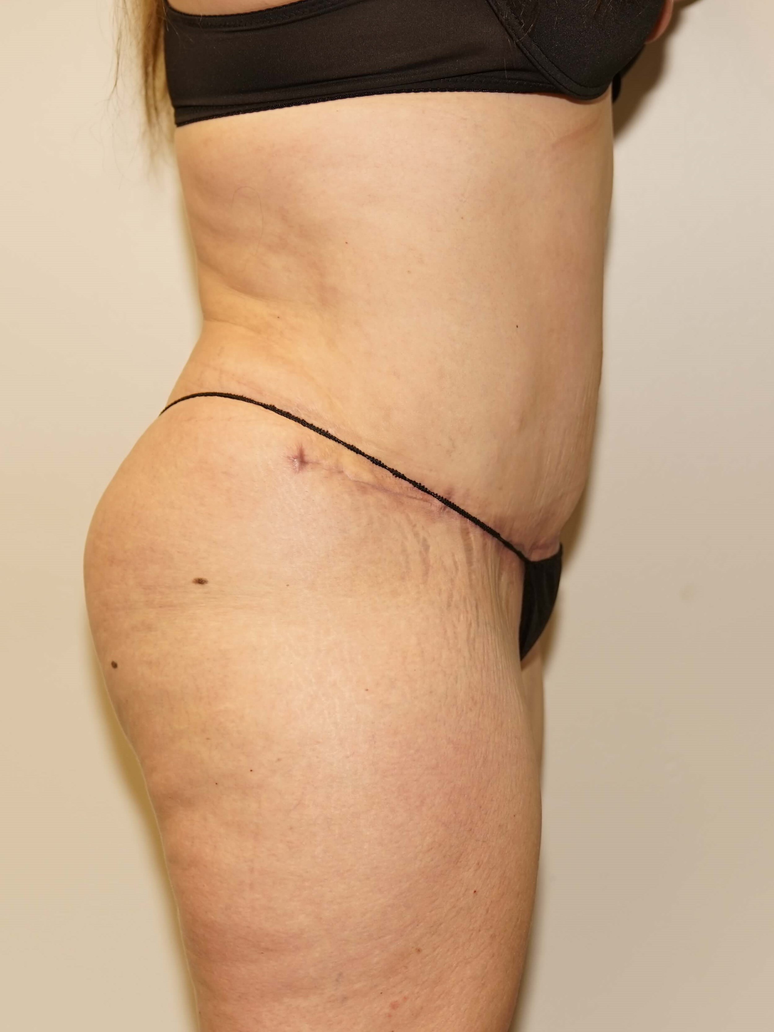 Woman has Tummy Tuck + Lipo After