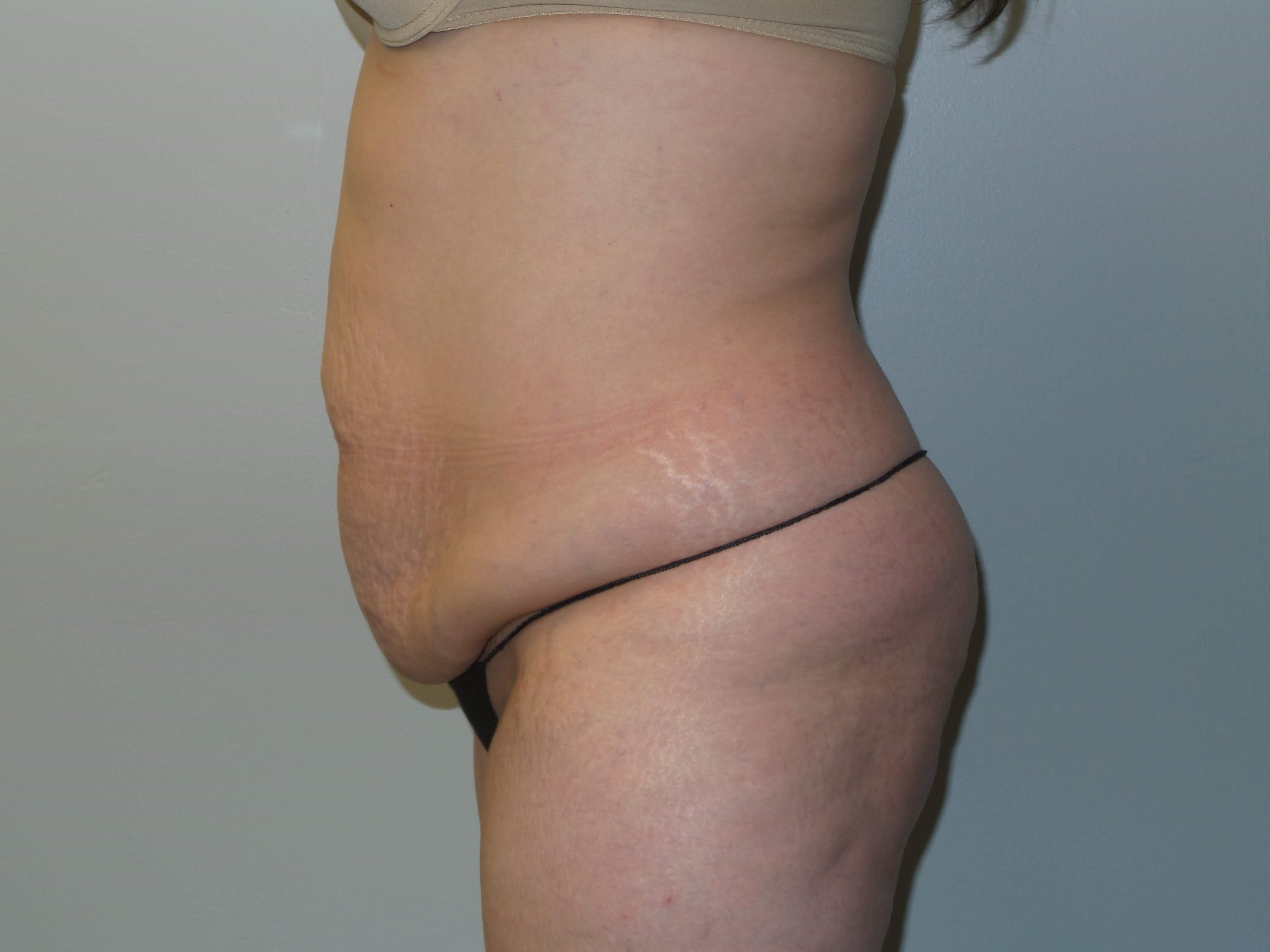 Woman has Tummy Tuck + Lipo Before