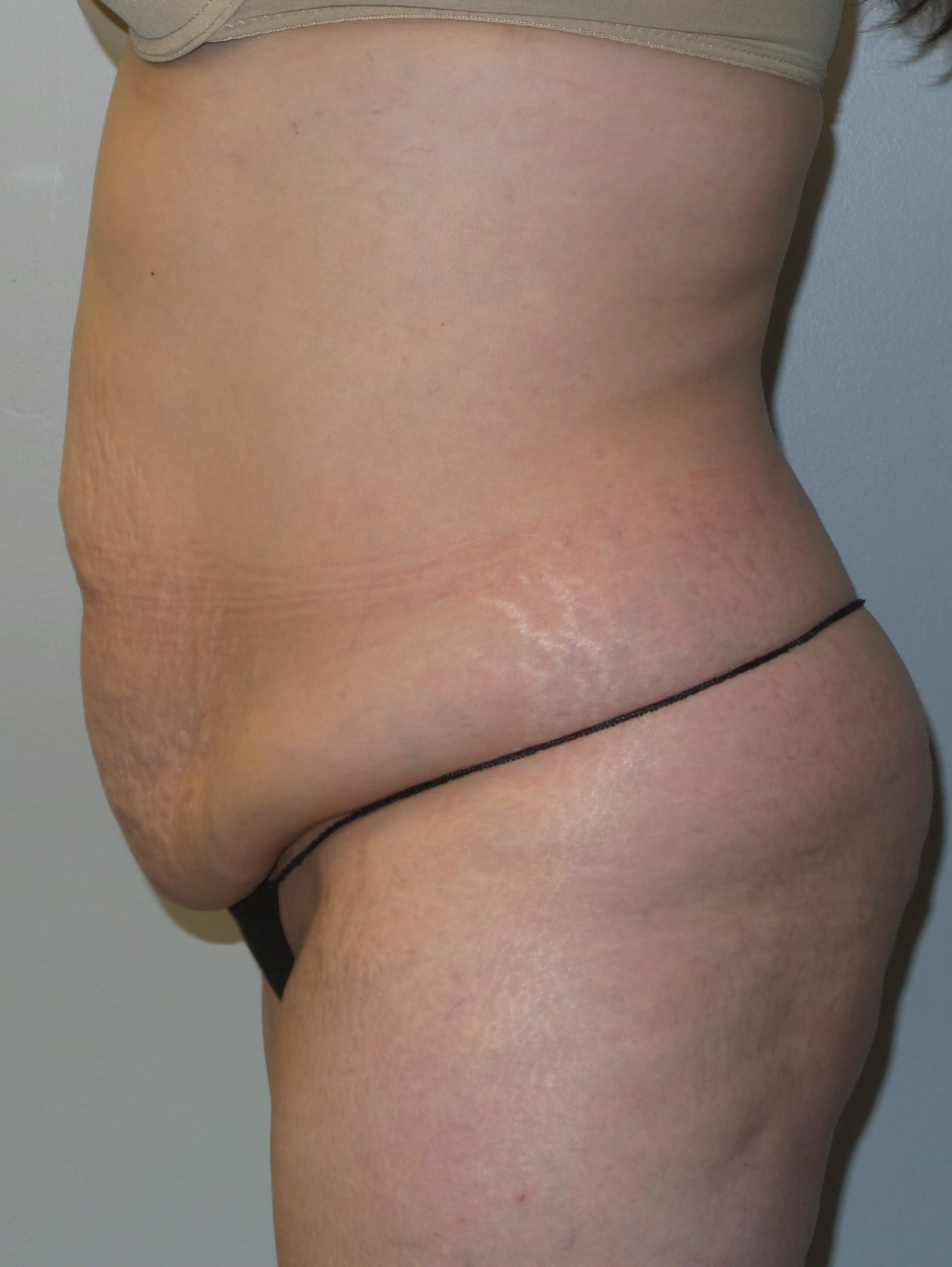 Woman has Tummy Tuck + Lipo Before