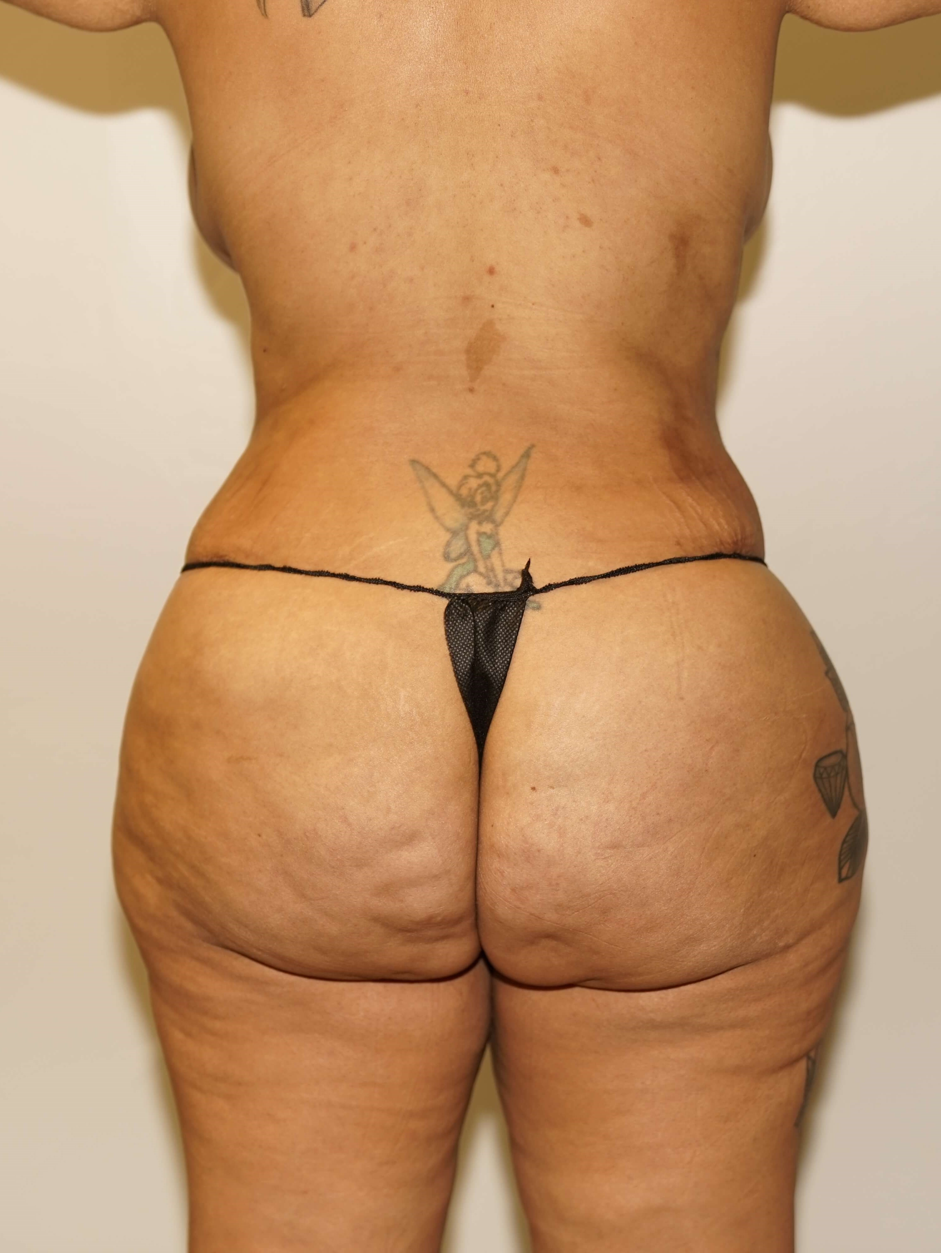 Woman has BBL Butt Lift After