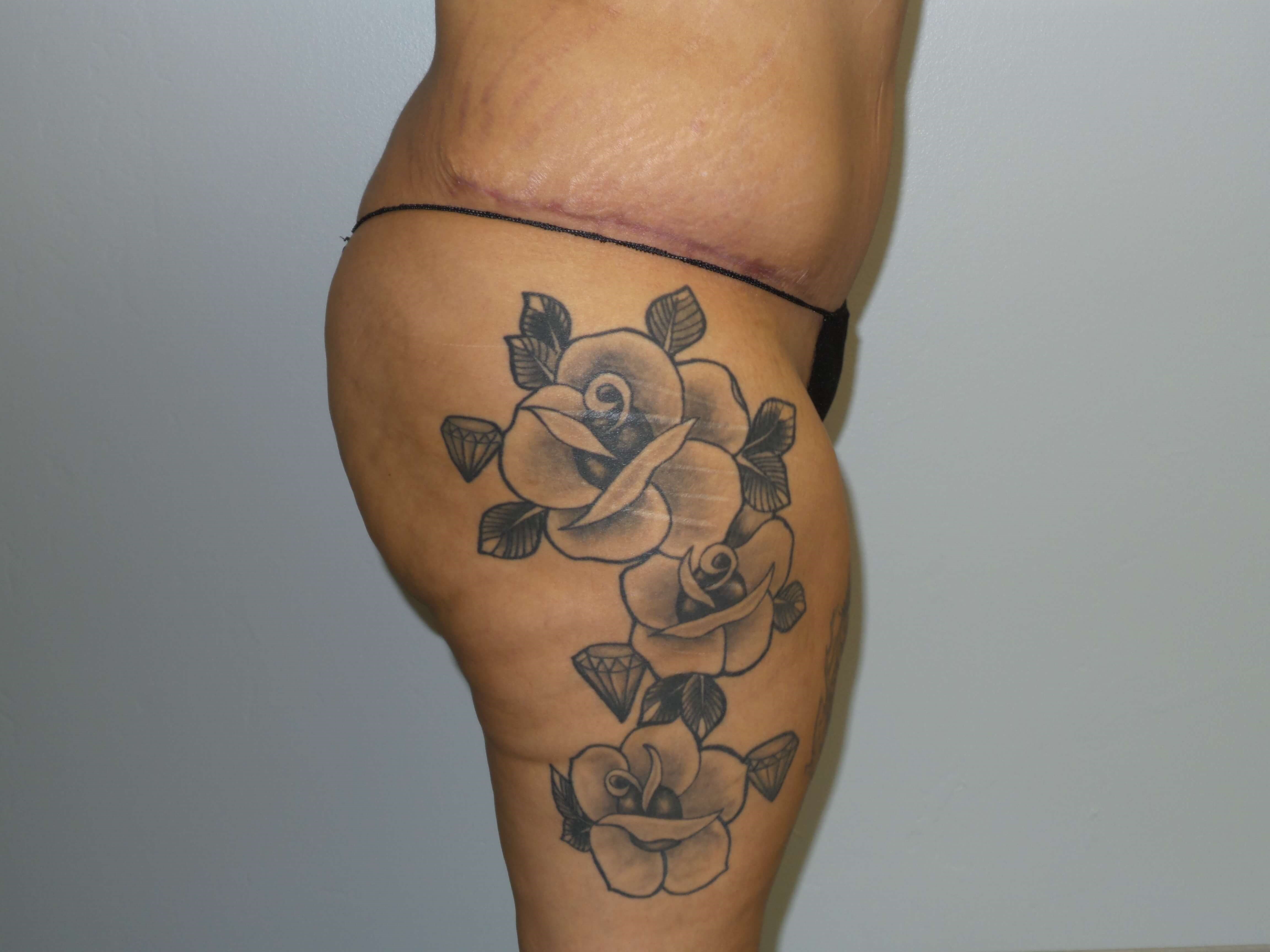 Woman has BBL Butt Lift Before