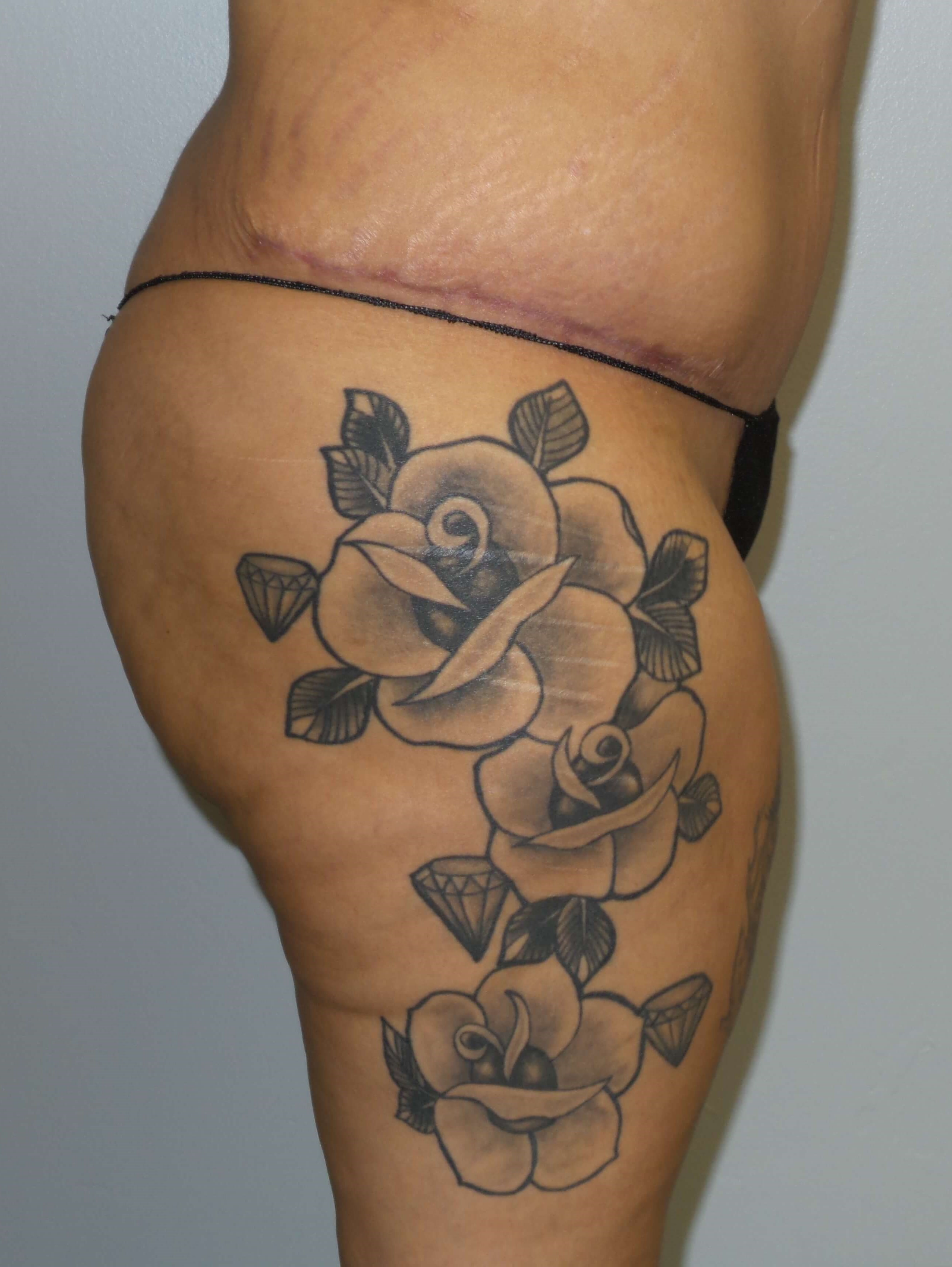 Woman has BBL Butt Lift Before
